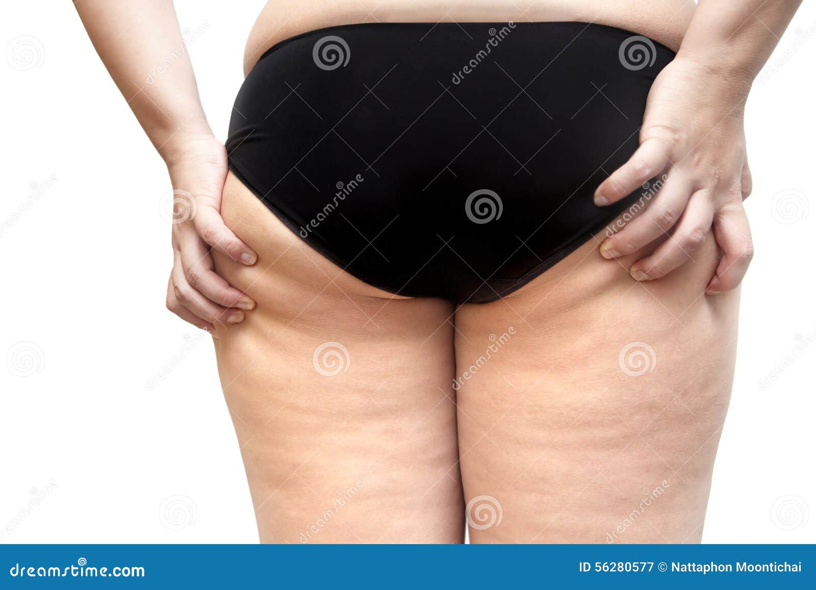 buttock and leg cellulite problem young fat woman stretch marks