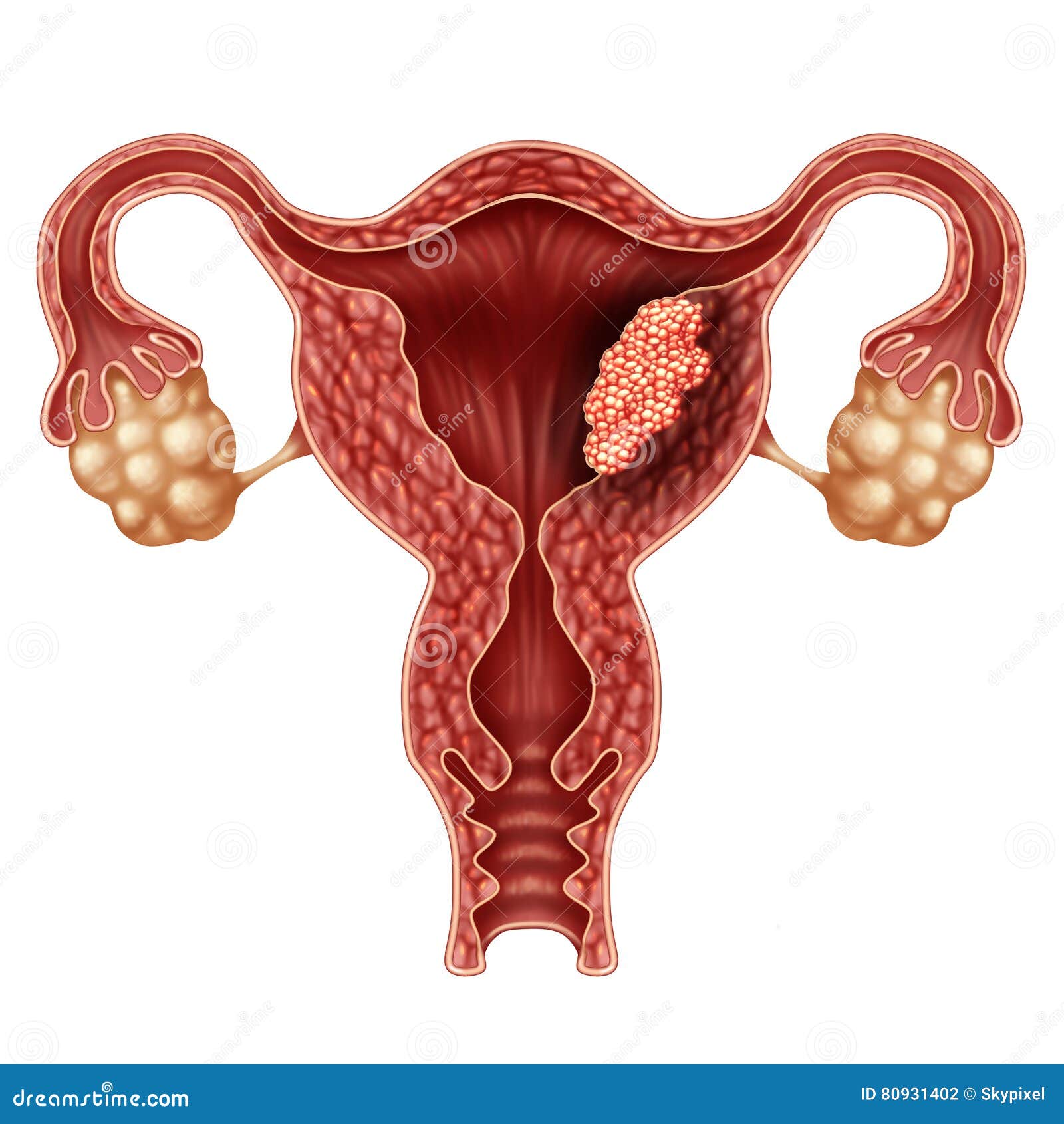 cancer endometrial speranta de viata)