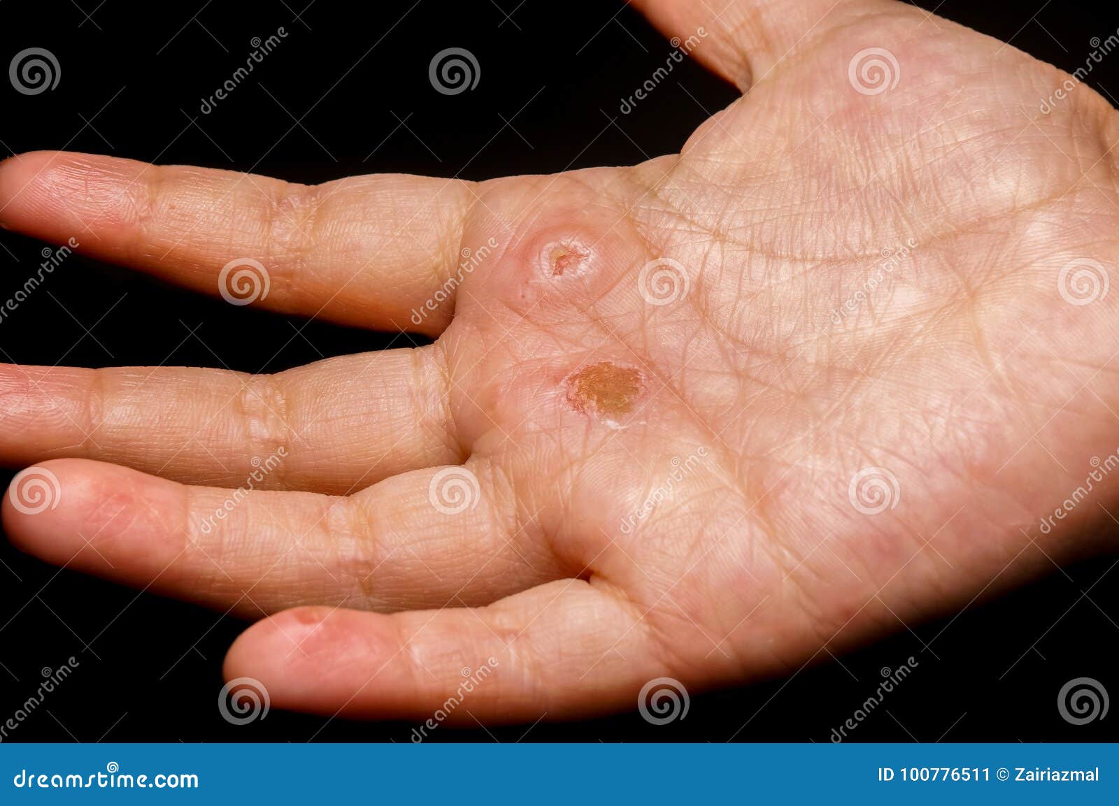 Caçoa a Palma Da Mão Da Eczema Imagem de Stock - Imagem de dermatologia,  varicela: 100776511, image size:1600x1153