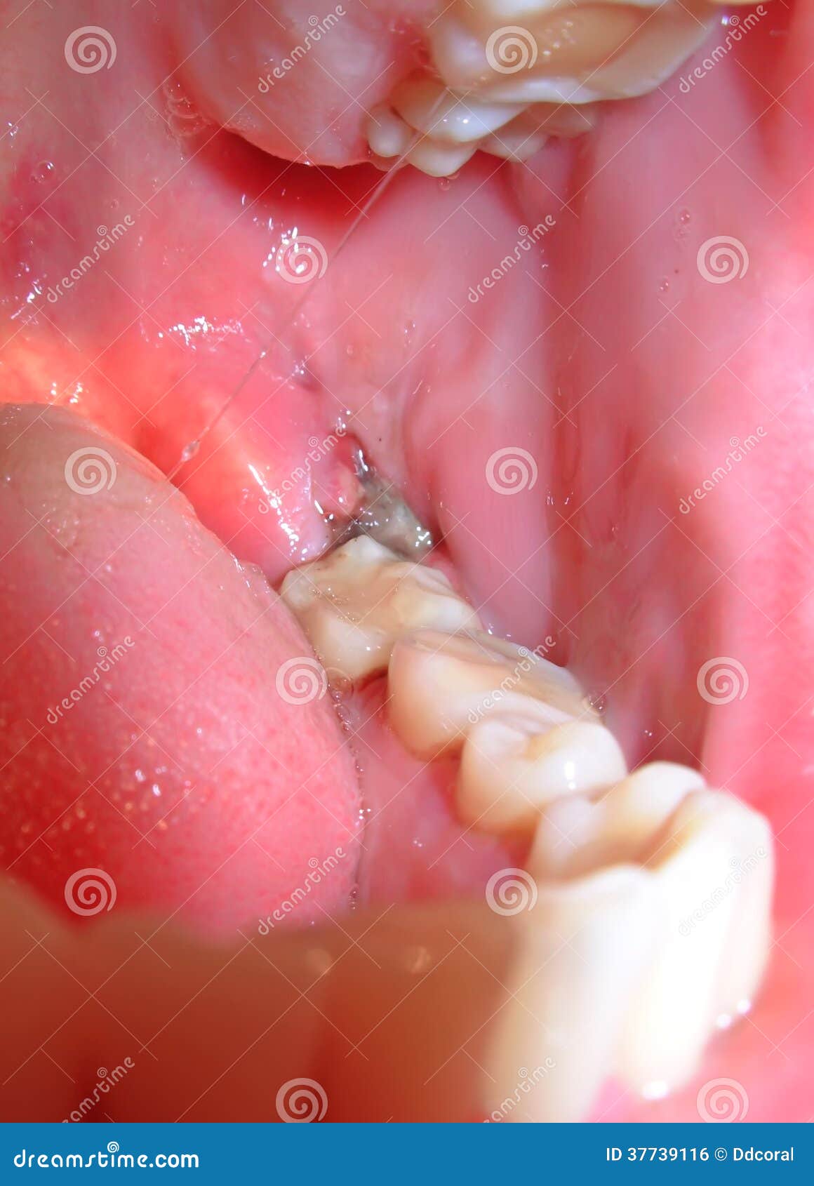 Caillot De Sang Photo Stock Image Du Medecine Infecter