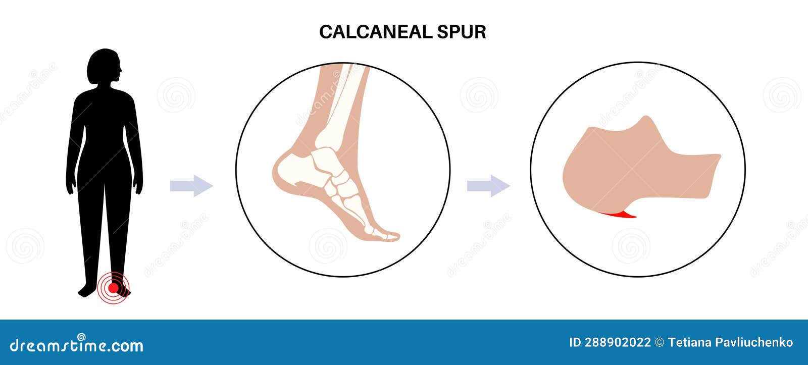 Calcaneal Spur - Carolina Regional Orthopedics