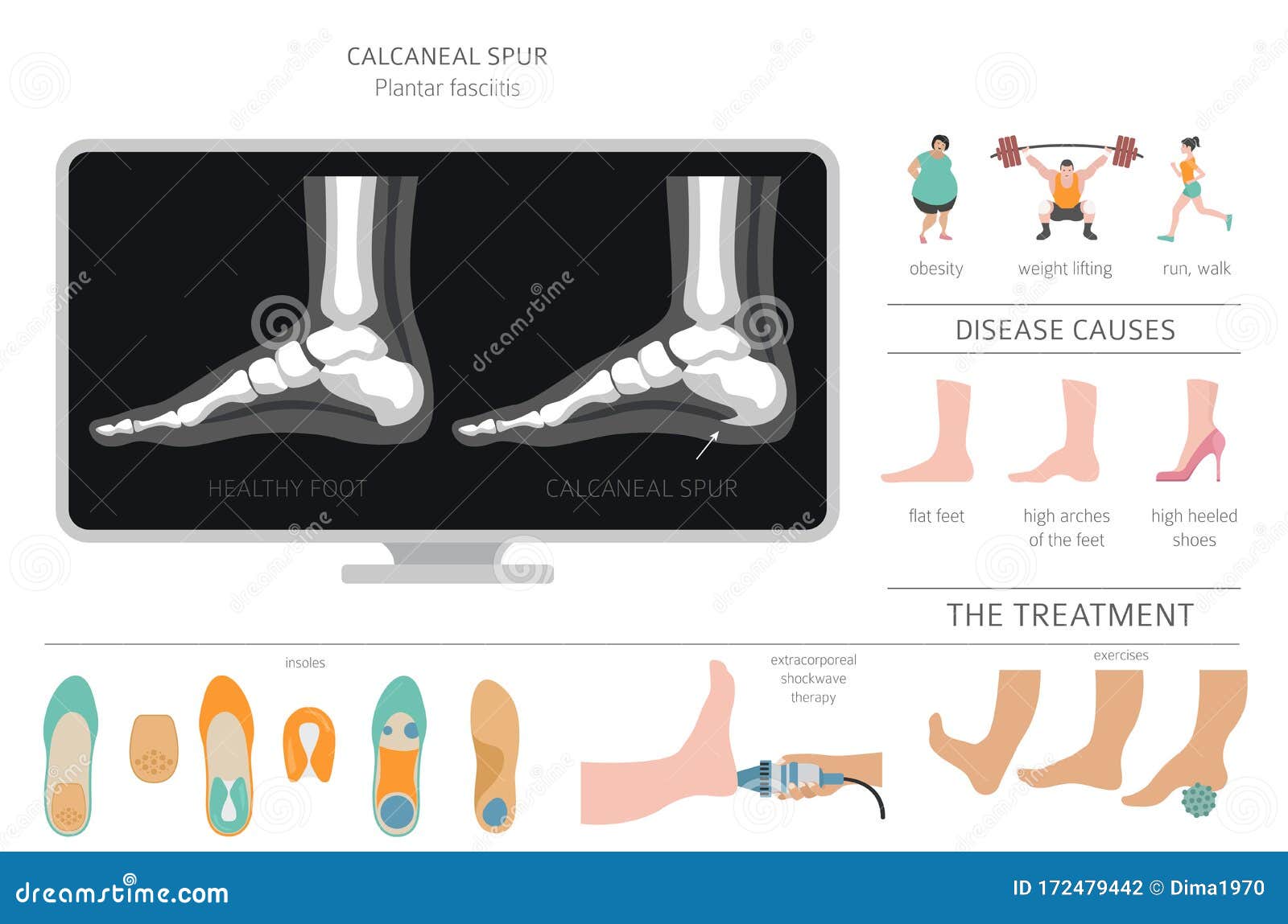 Heel spur: definition of this talalgia | Podexpert