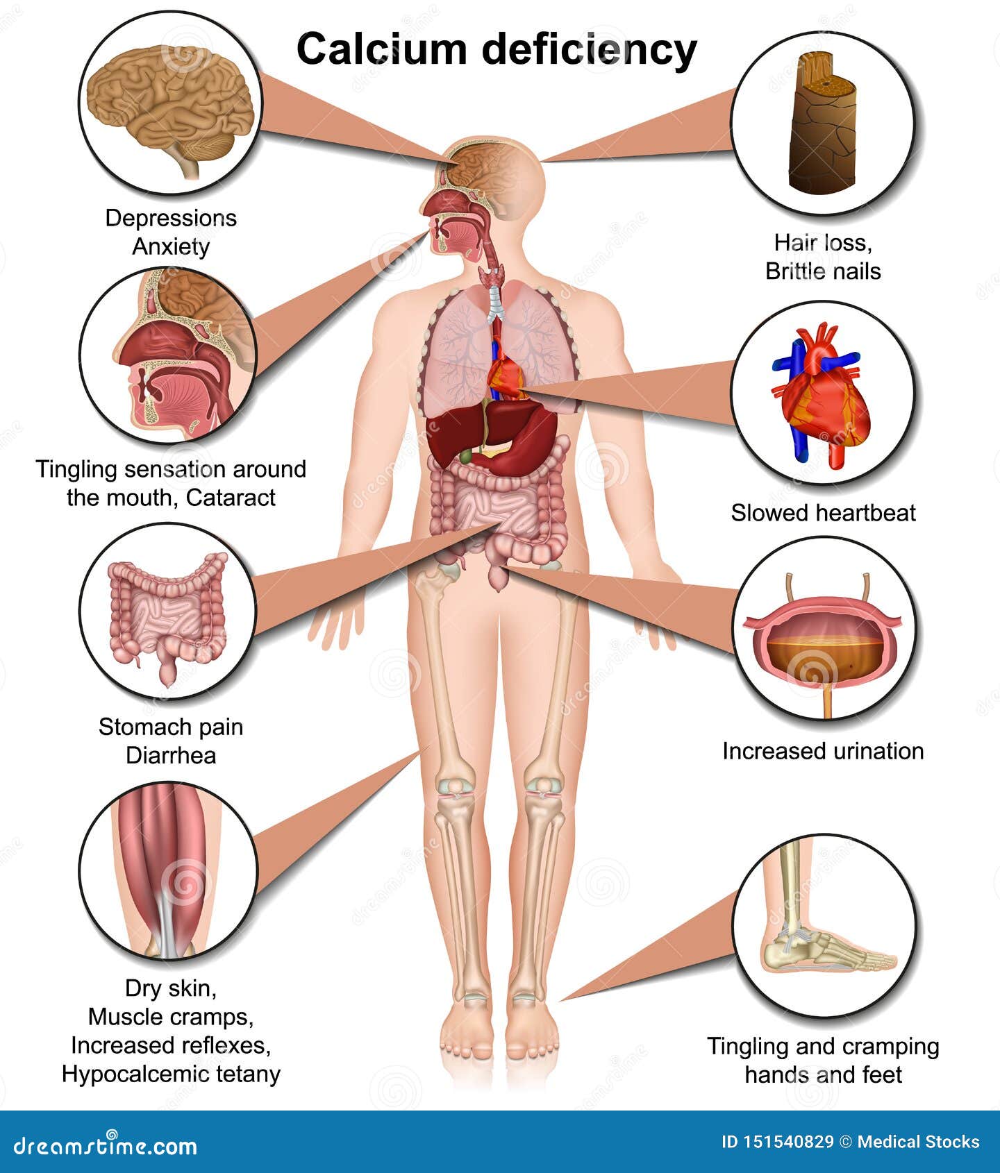 calcium deficiency medical    on white background infographic