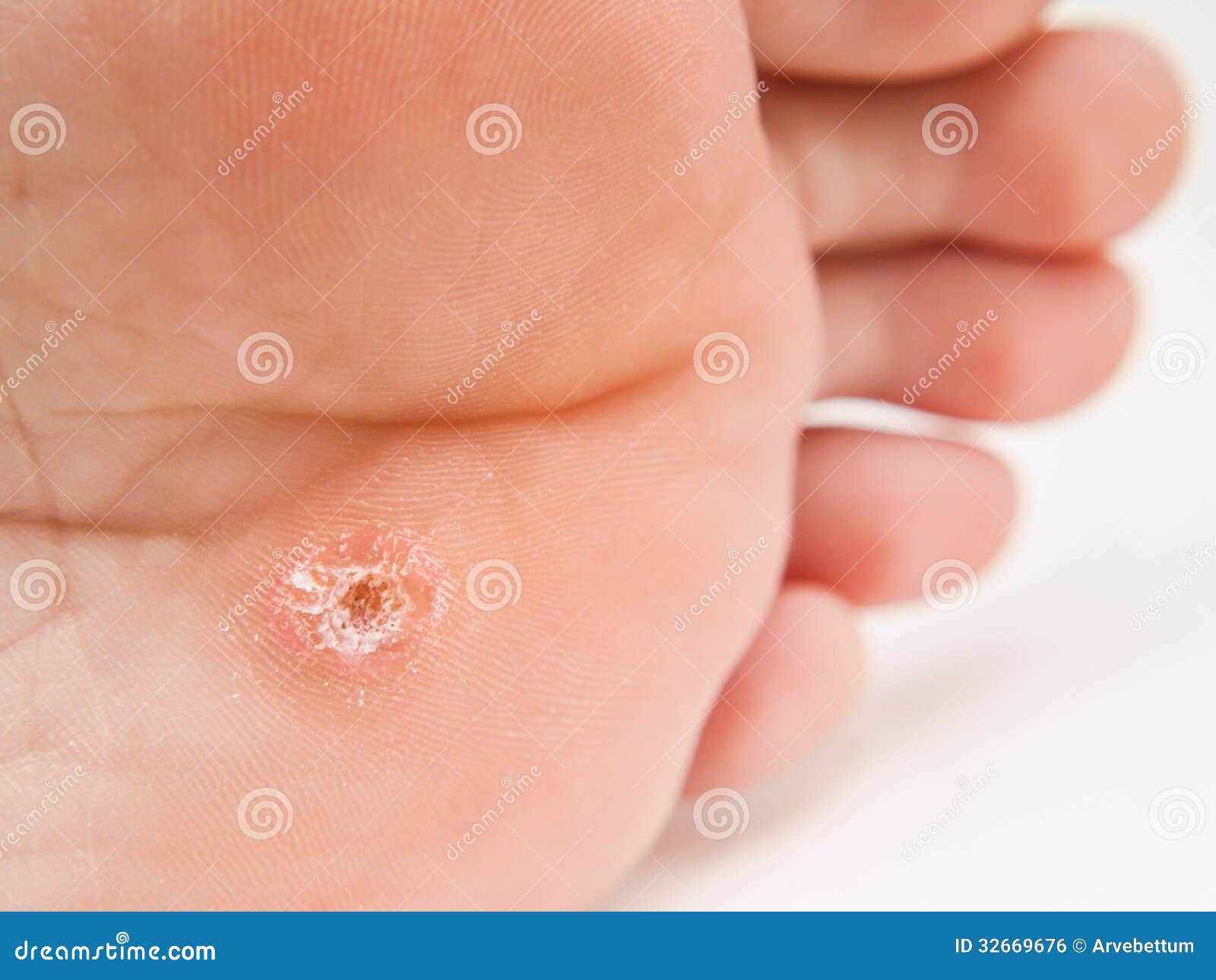 callus under foot