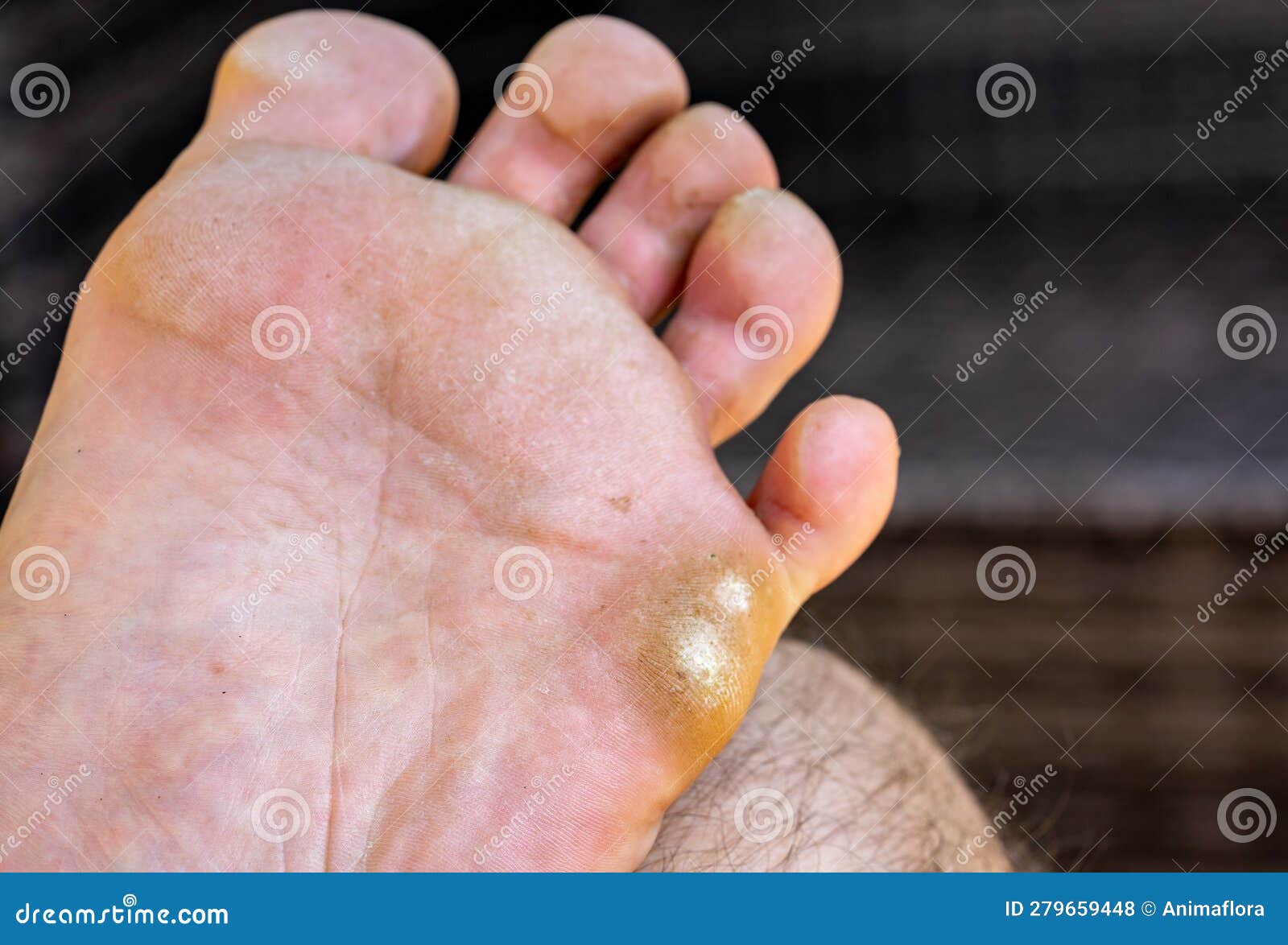 Calluses with Athlete S Foot and Warts on the Foot Stock Photo Image