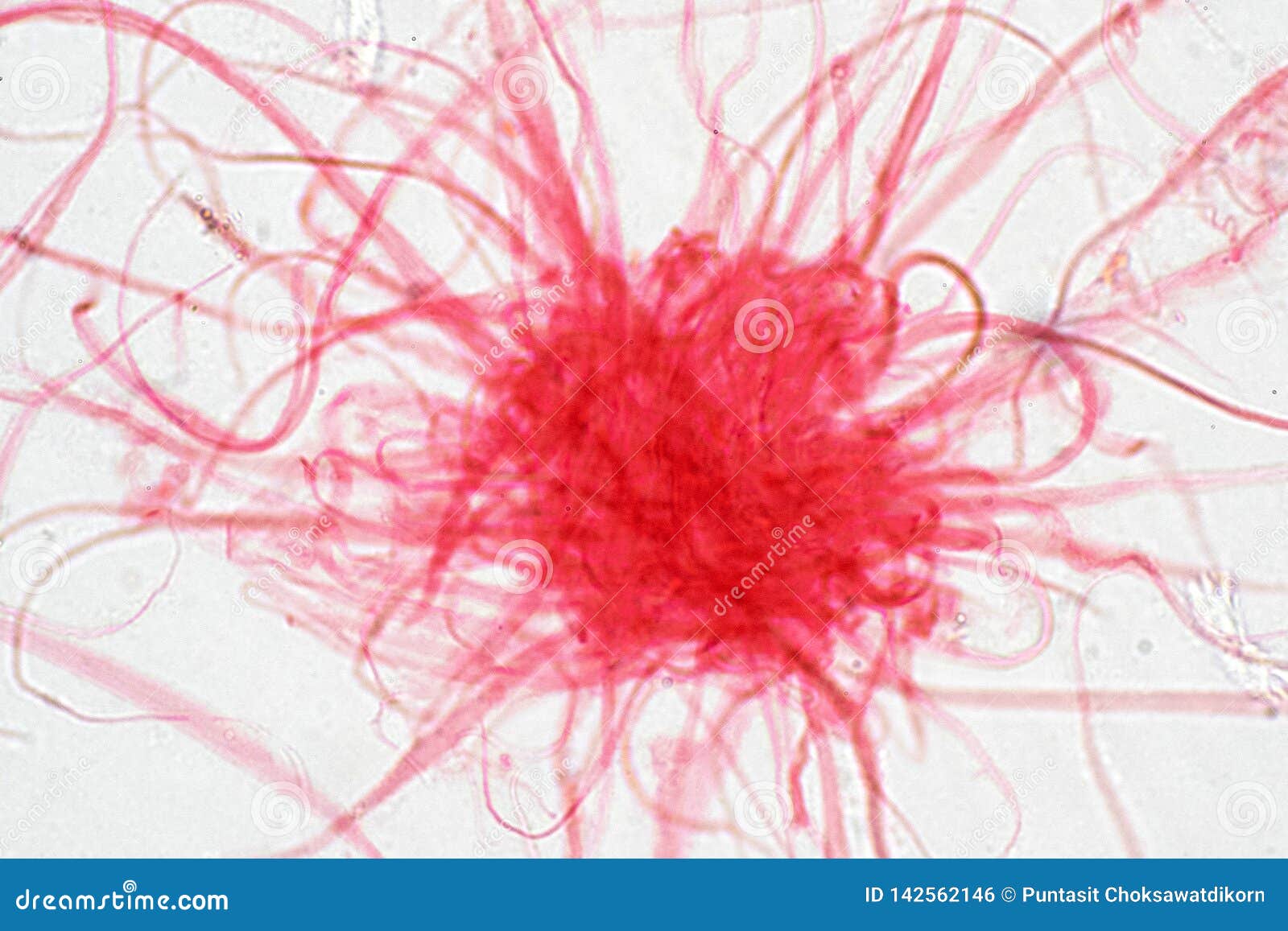 Cancer Cell In Human Under The Microscope View Stock Photo - Image of