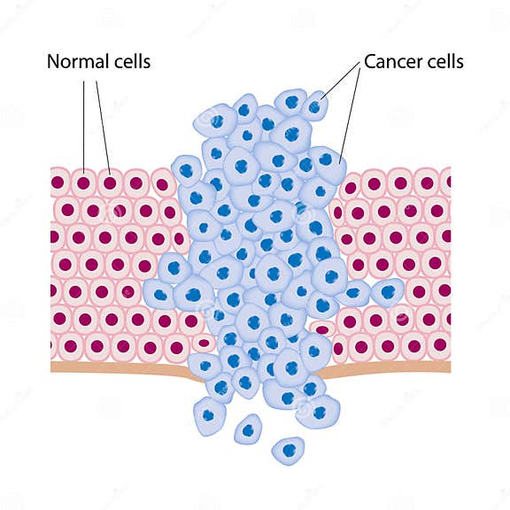 Cancer cells stock vector. Illustration of epithelial - 25664276