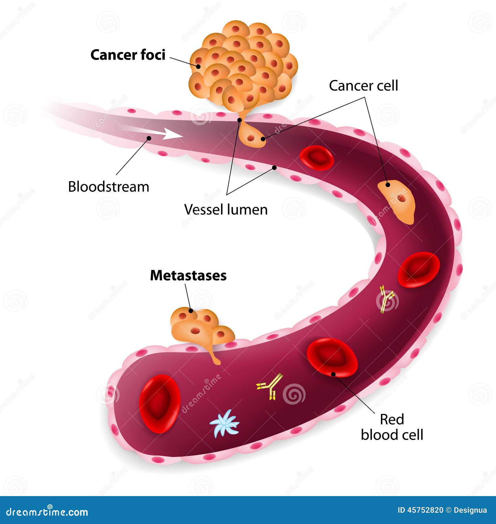 cancer cells, cancer foci and metastases