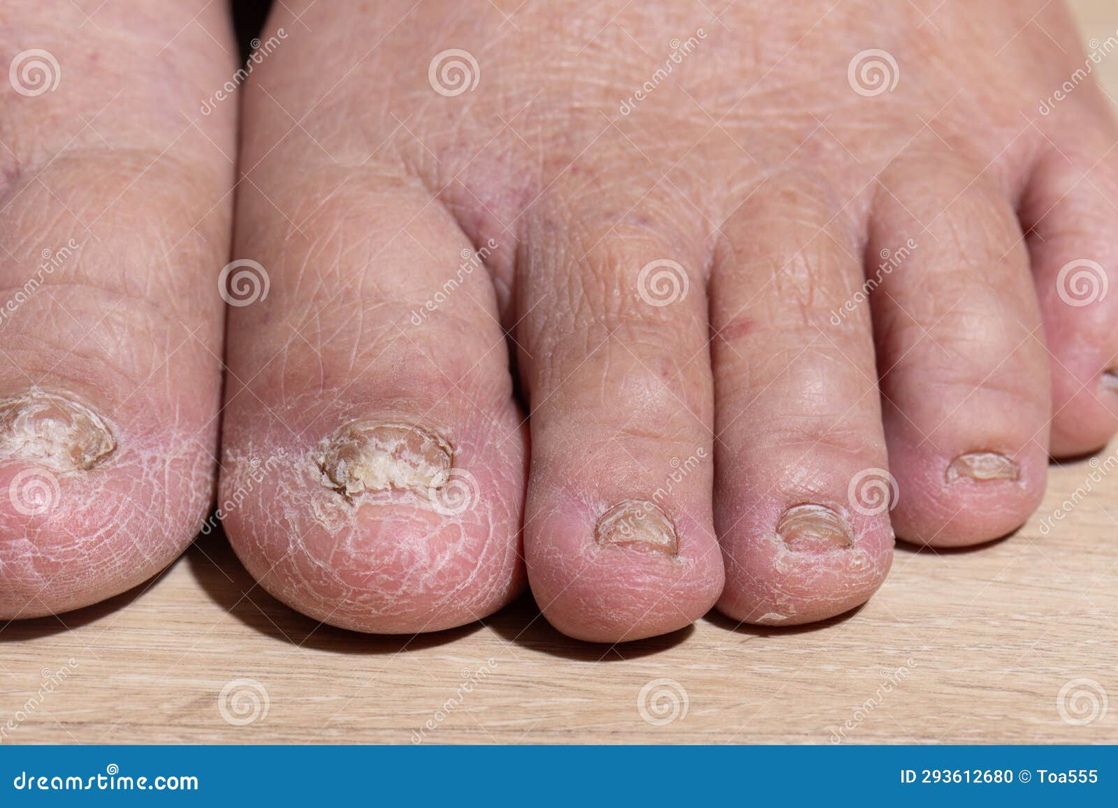 cancer chemotherapy cause swelling of ankles . skin to become dry, dark or peel and nails brittle or flaky