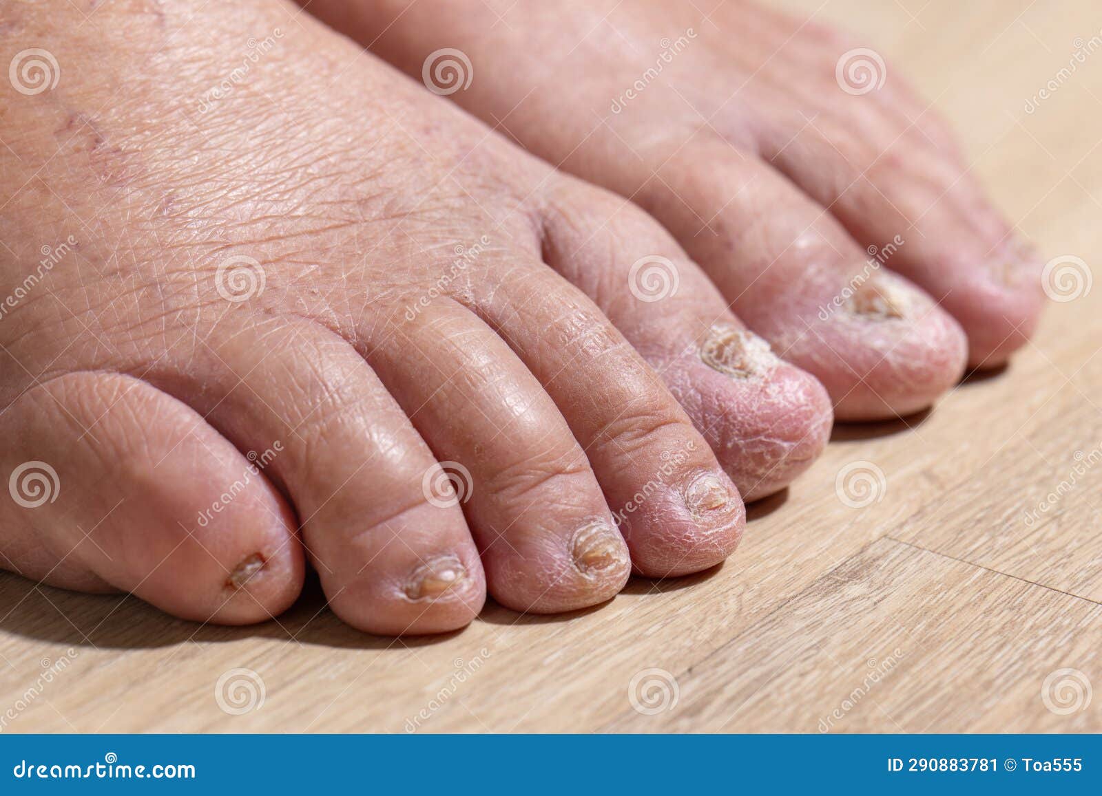 cancer chemotherapy cause swelling of ankles (ankle oedema) , . skin to become dry, peel and nails brittle or flaky