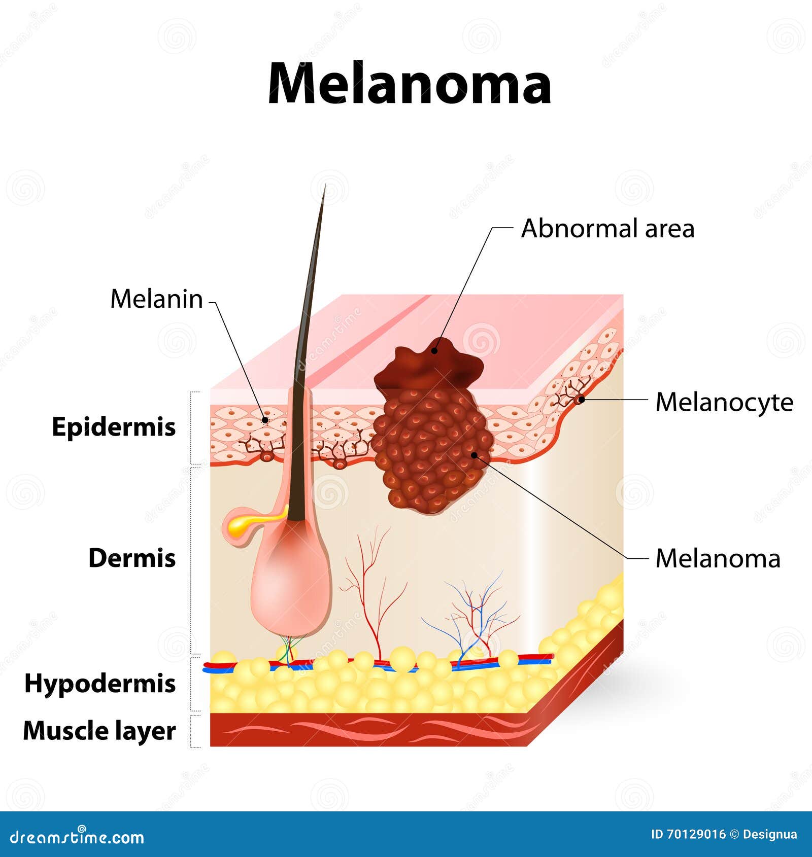Basal cell skin cancer: MedlinePlus Medical Encyclopedia
