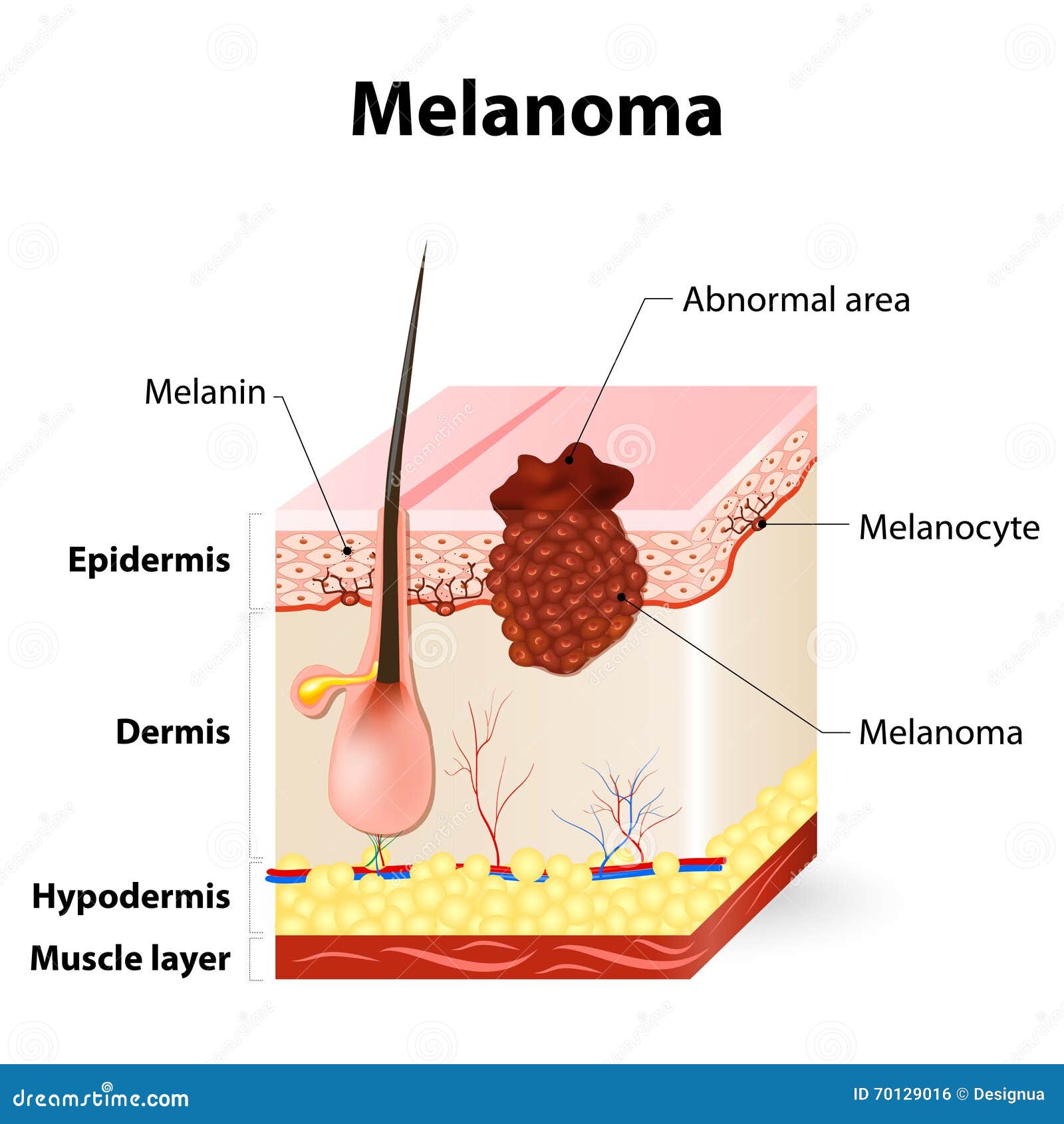 Basal Cell Carcinoma (BCC) - SkinCancer.org