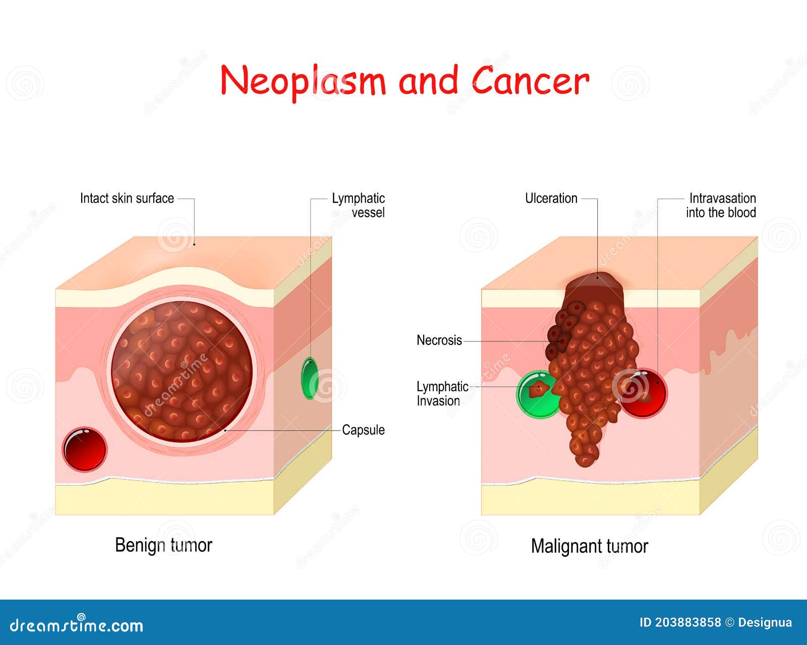 cancer cells benign malignant)