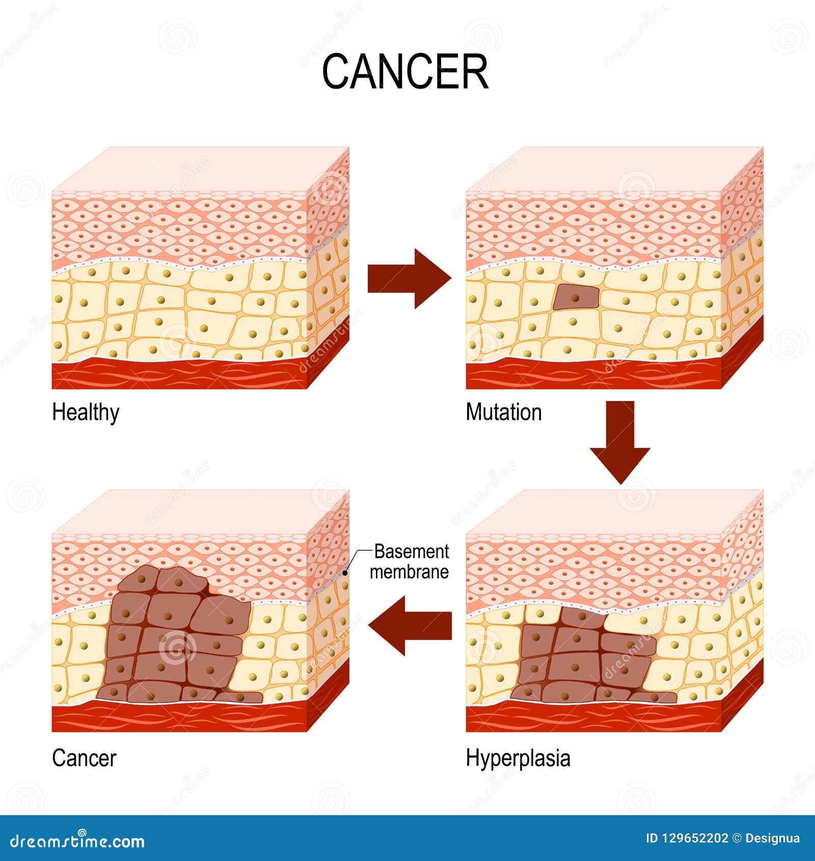 Cancer And Normal Cells Comparison And Difference Vector Illustration 