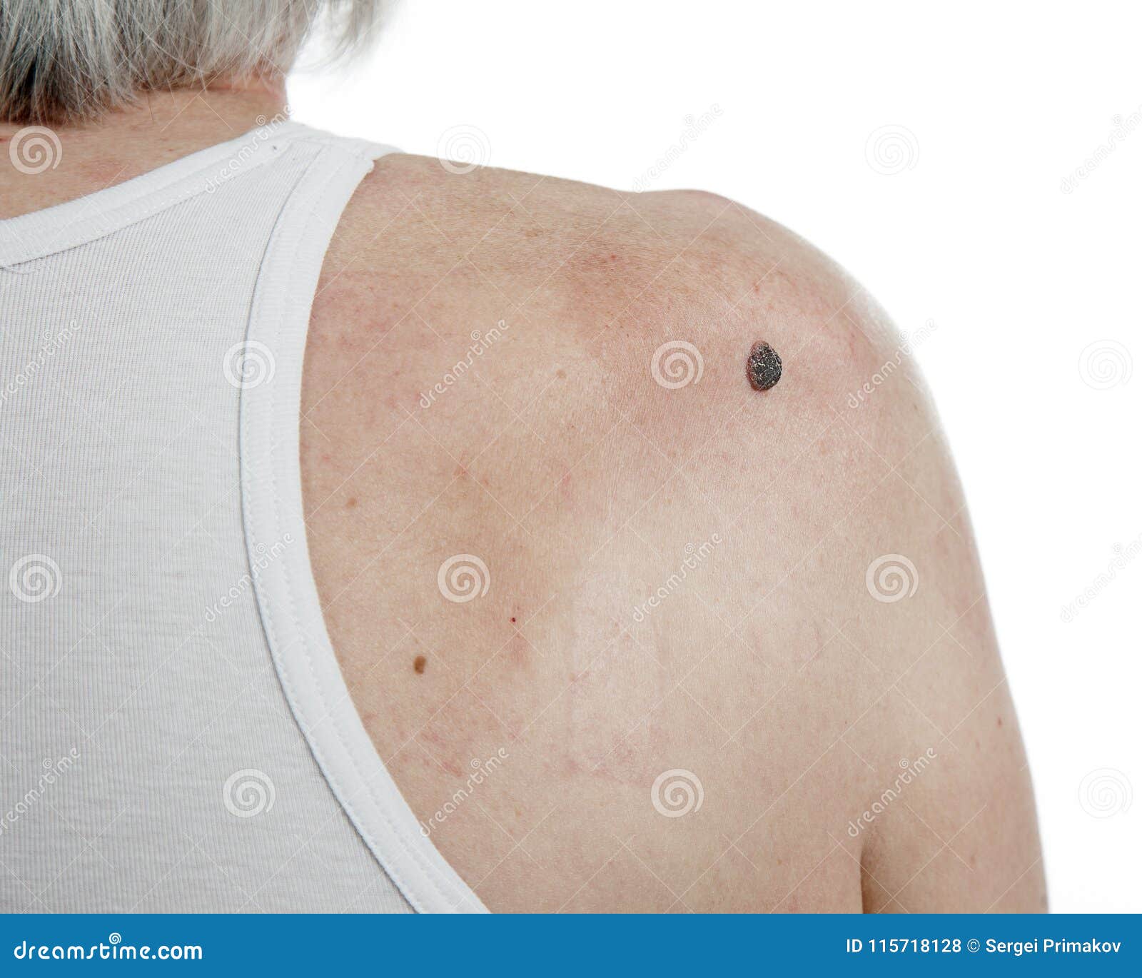 Uomo Cancro Se Gli Manchi Cancro di pelle in uomini fotografia stock. Immagine di medicina