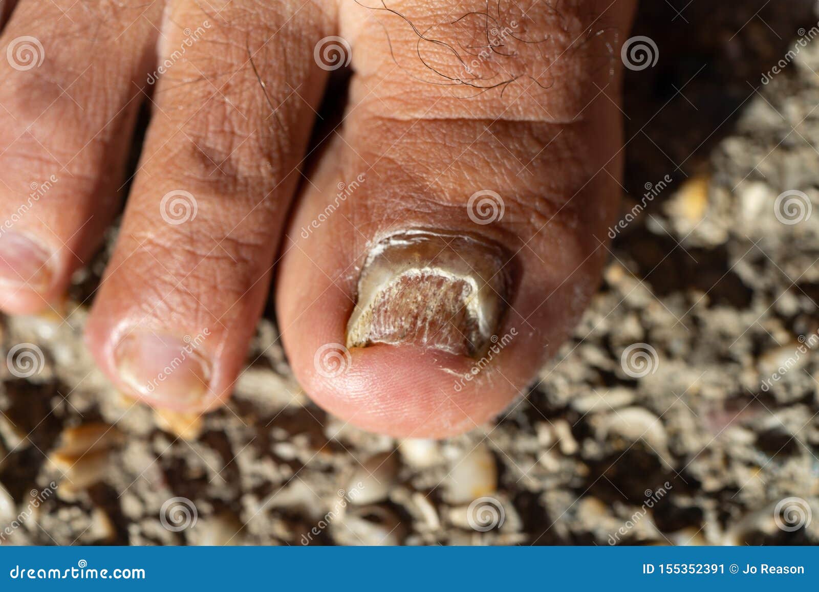 Candida Albicans toe nail stock image. Image of infection 155352391