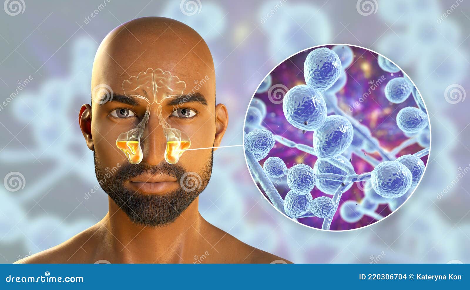 candida fungi as a cause of sinusitis