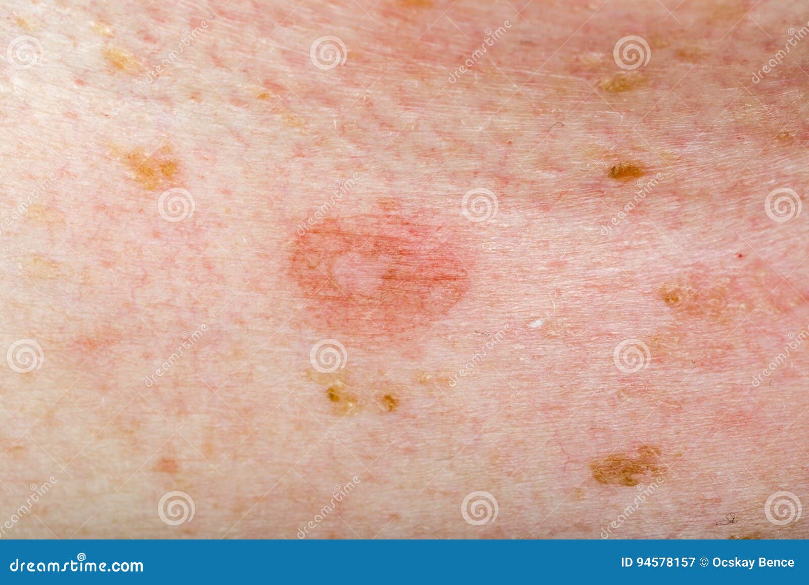 Candida Infection On Human Skin Stock Image Image Of Infection