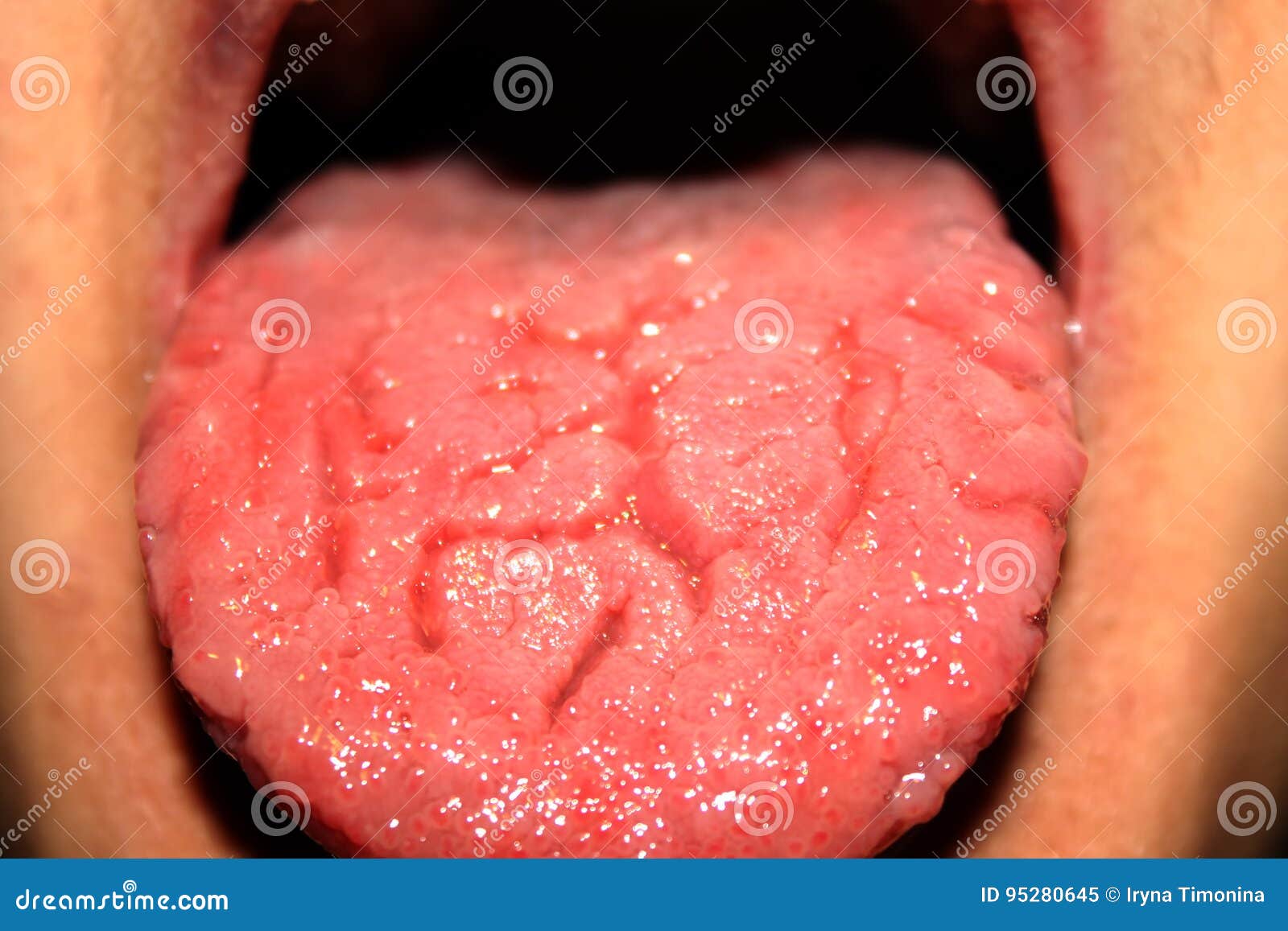 Candidiasis In The Tongue White Coating Thrush Stock