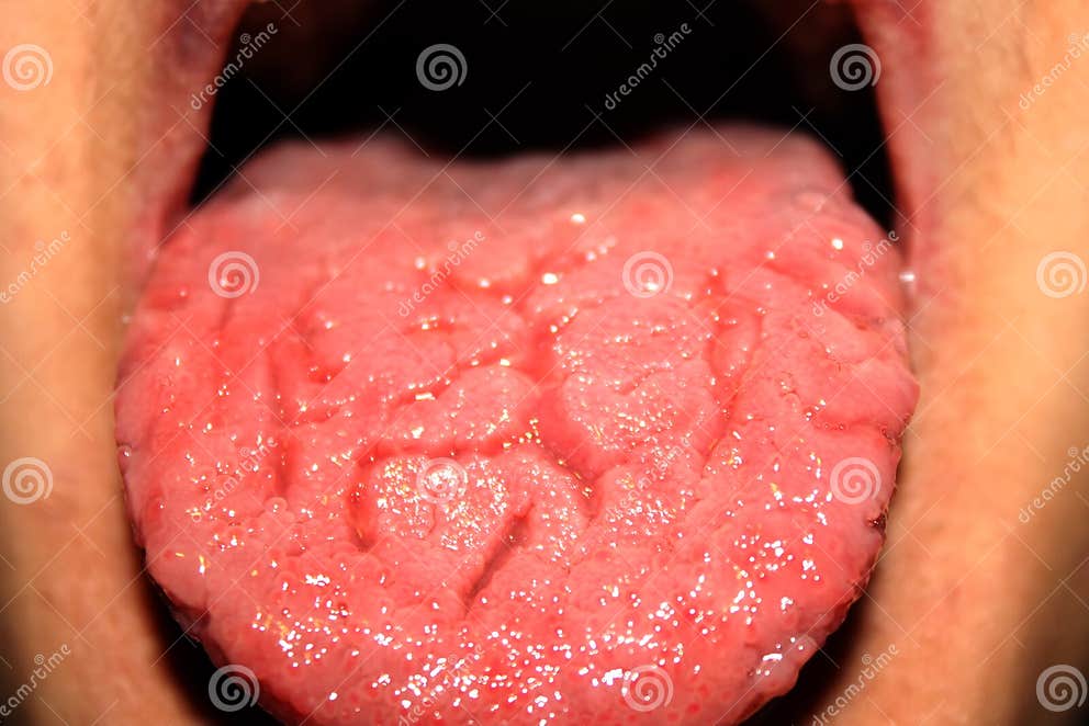 Candidiasis in the Tongue. White Coating. Thrush. Stock Image Image
