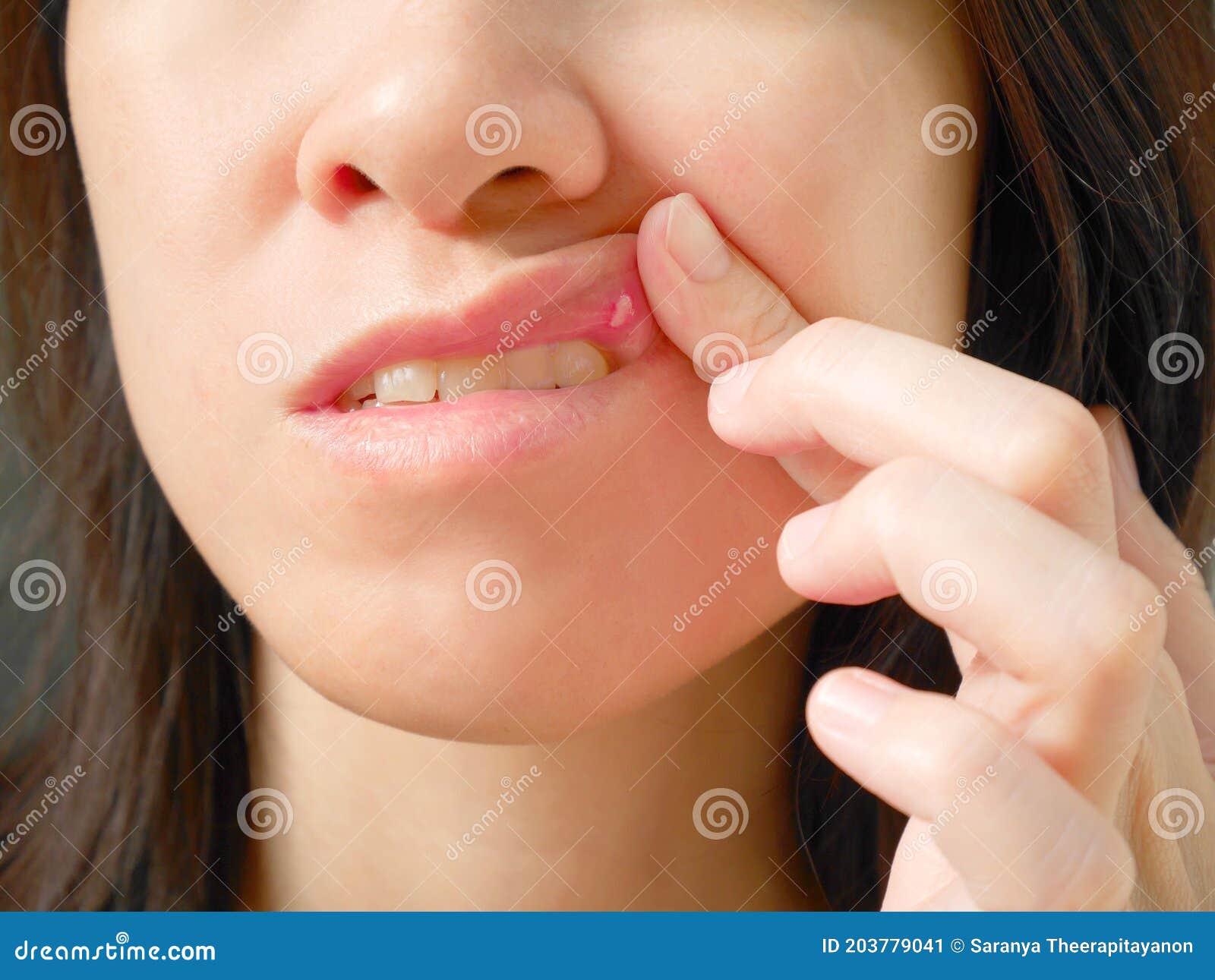 canker sore on woman upper lip