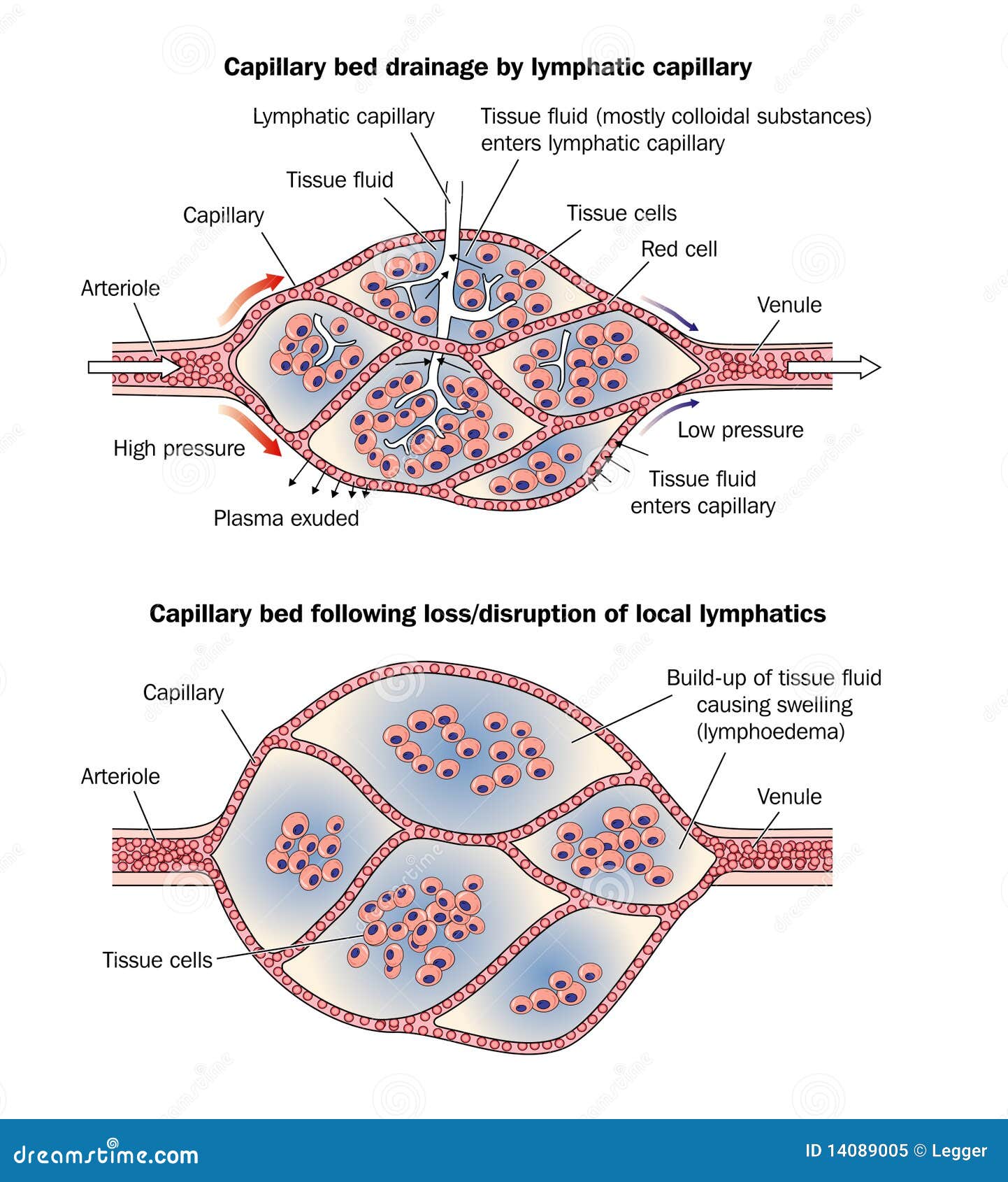 Capillary Bed Lymphoedema Royalty Free Stock Photo - Image 