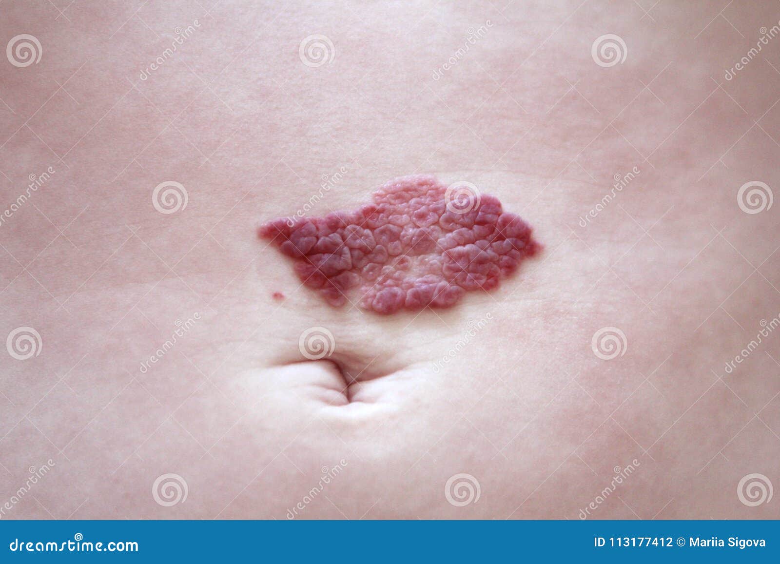 capillary hemangioma regression. red birthmark on the baby`s belly after treatment