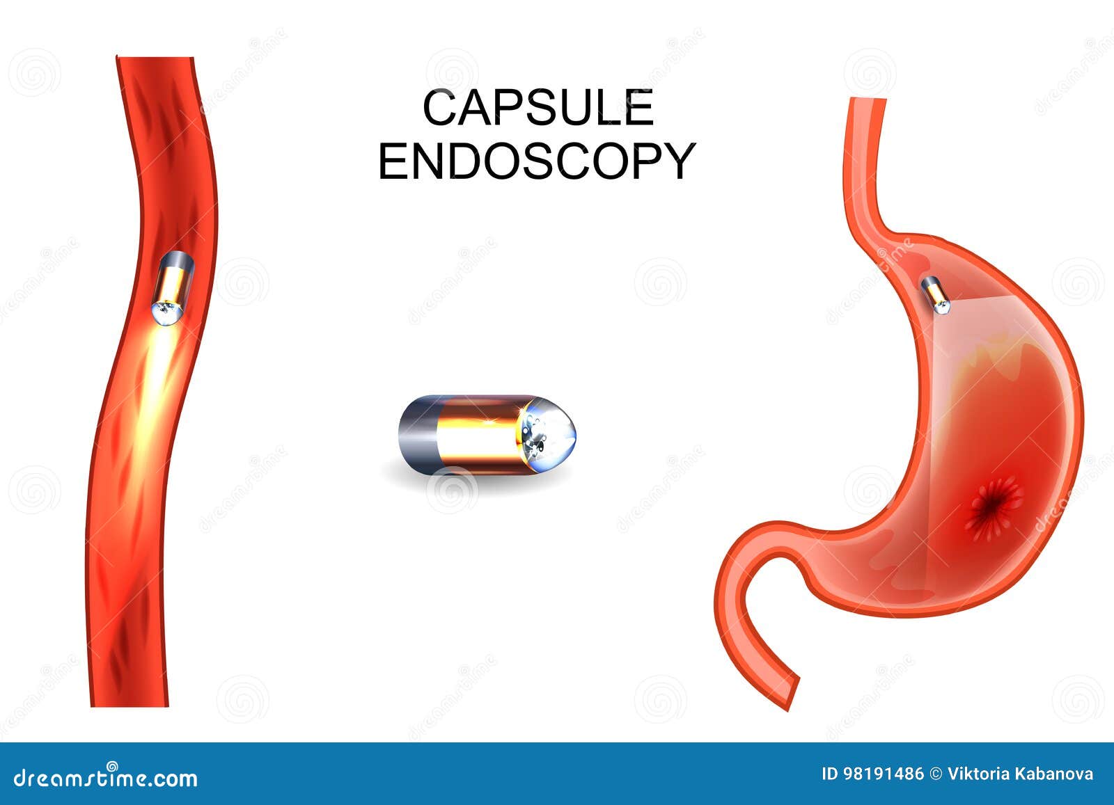 capsule endoscopy. egd, gastroenterology.