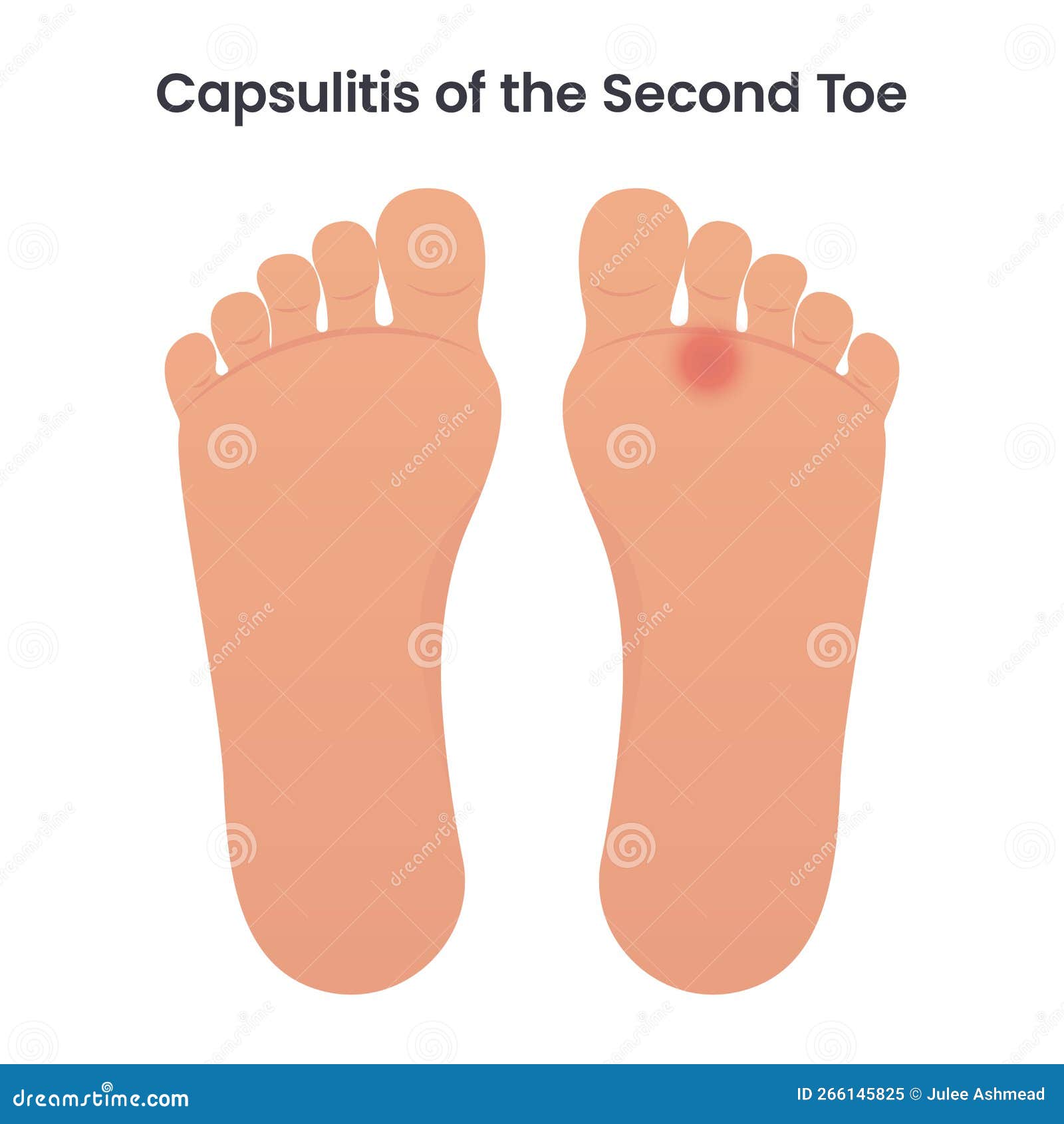 capsulitis of the second toe medical   graphic