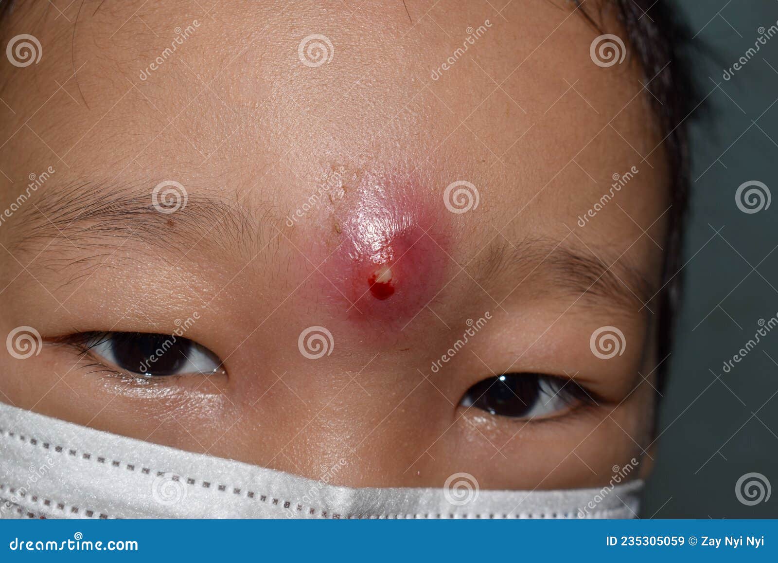 Carbuncle or Abscess at Forehead Stock Image Image of sore, acne
