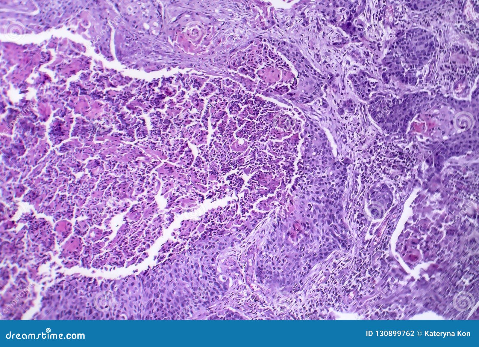 Carcinoma De Células Escamosas Del Pulmón Foto De Archivo Imagen De