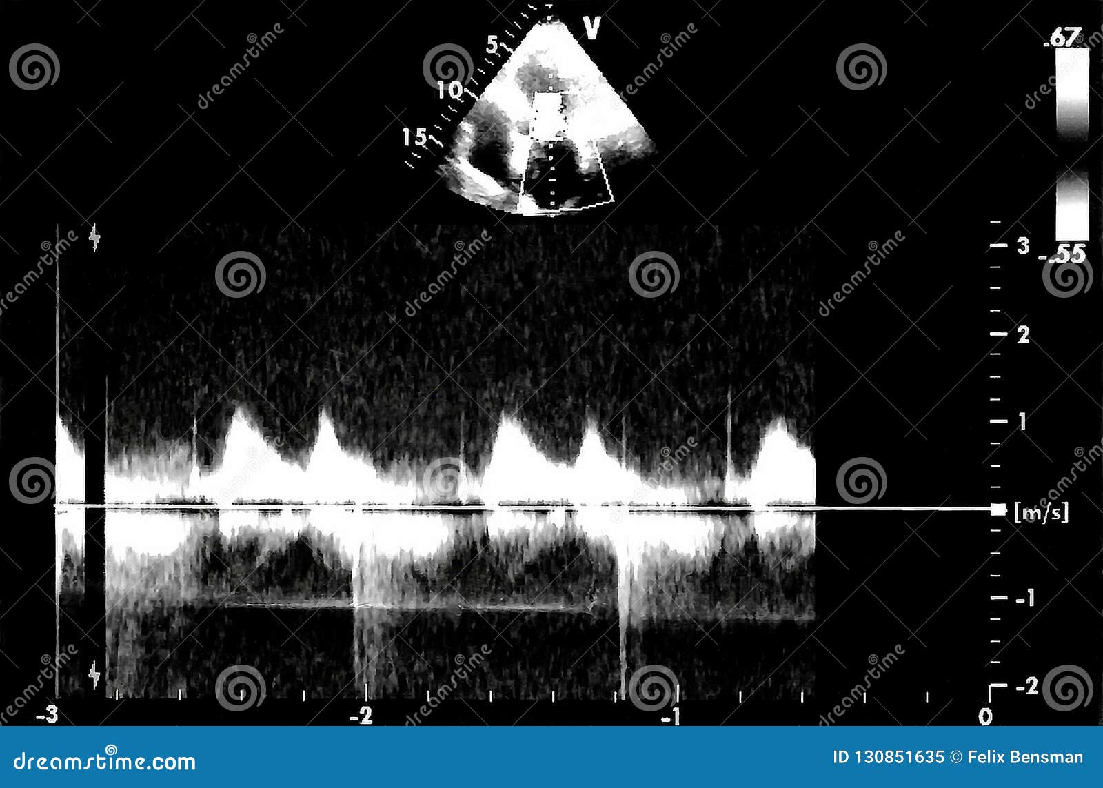 Cardiac Ultrasound Images . Doppler Echo Royalty-Free Stock Photography