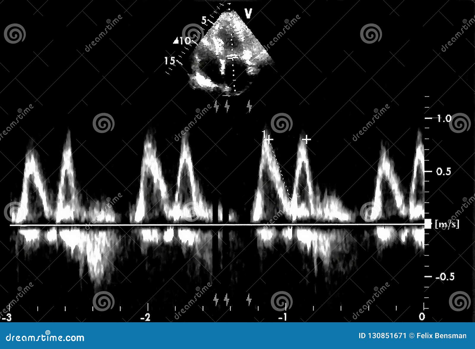 Cardiac Ultrasound Images . Doppler Echo Stock Image - Image of cardio