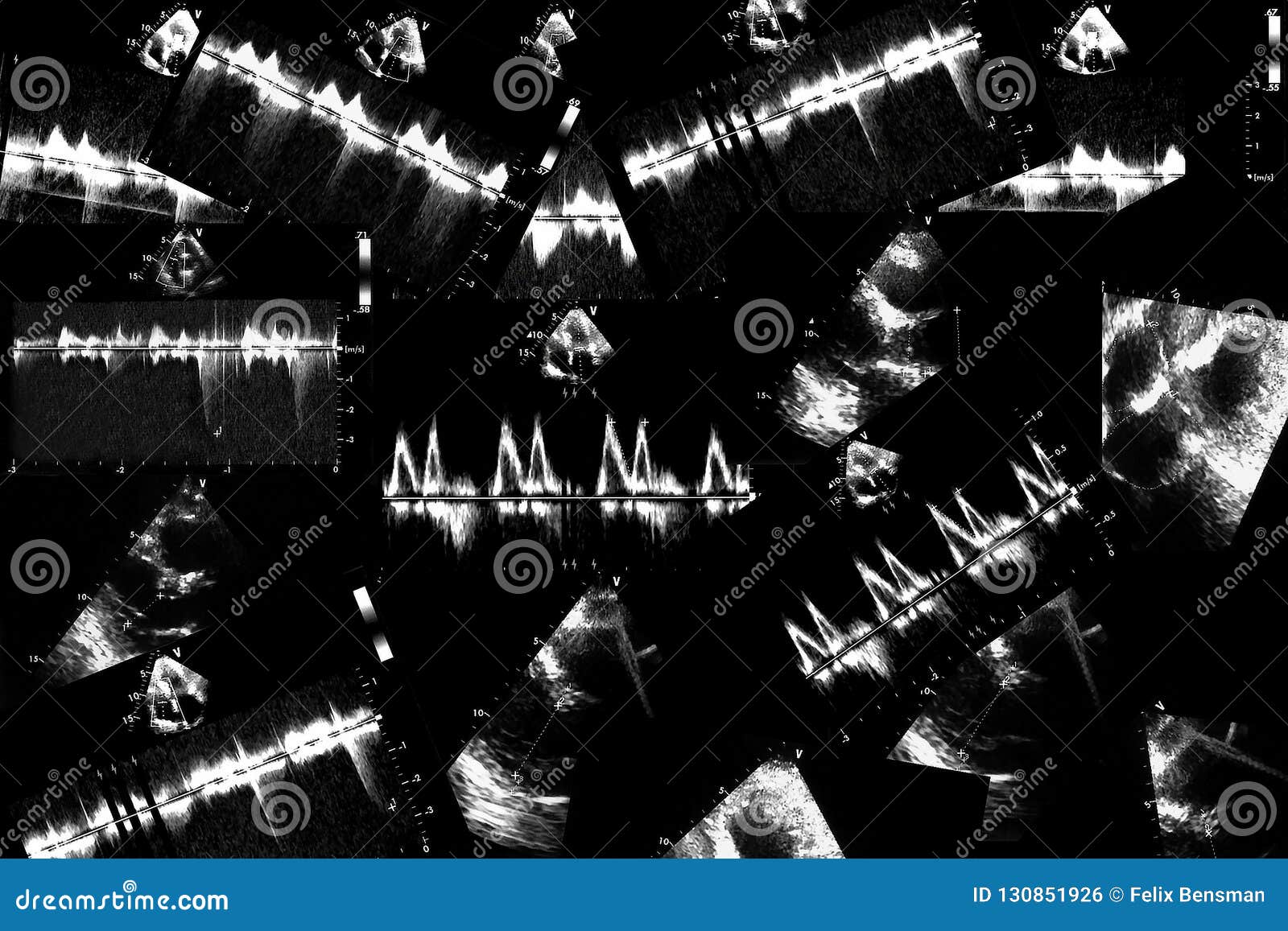 Cardiac Ultrasound Images . Doppler Echo Stock Photo - Image of