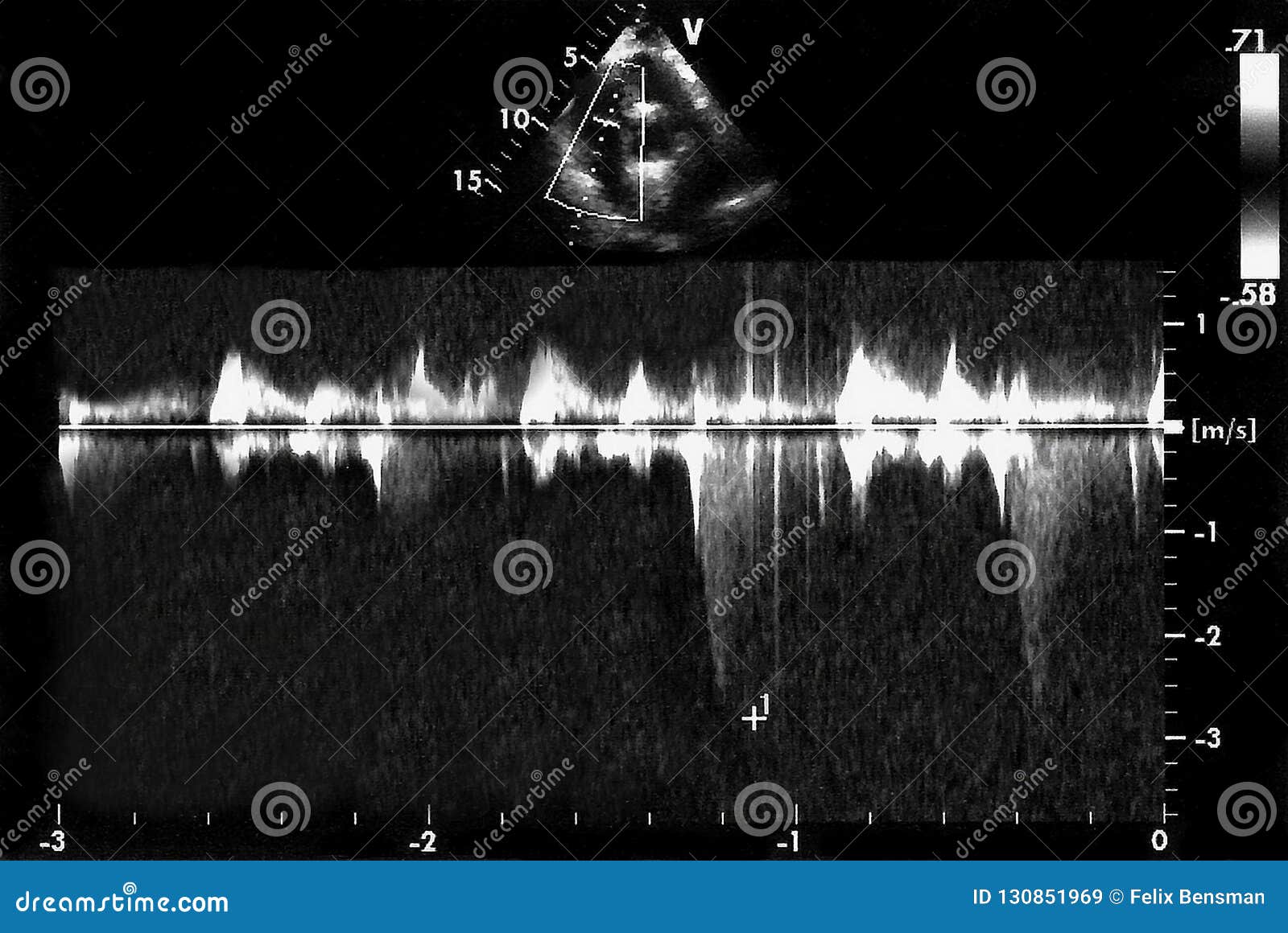 Cardiac Ultrasound Images . Doppler Echo Stock Image - Image of mitral