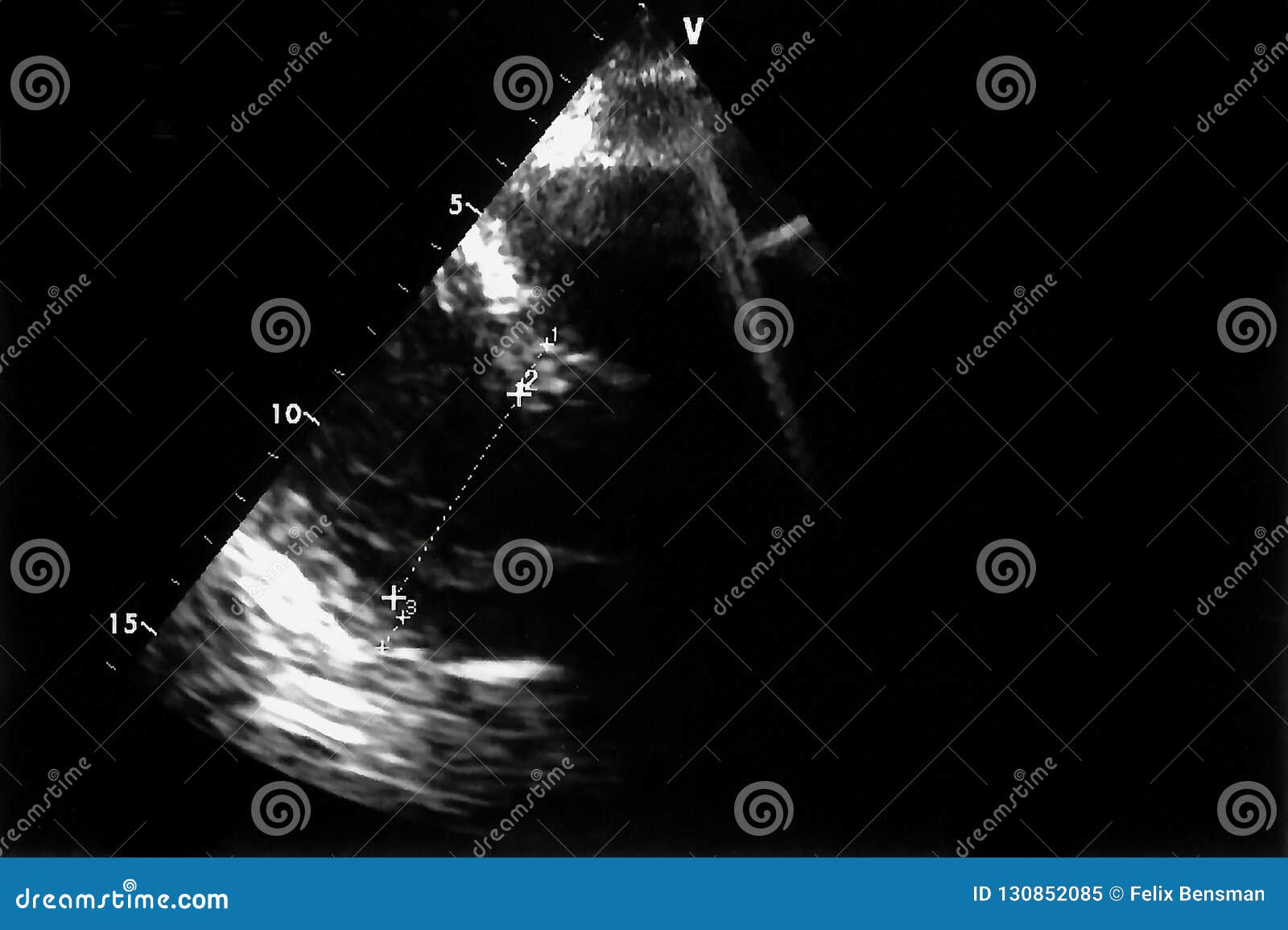 Cardiac Ultrasound Images . Doppler Echo Stock Image - Image of