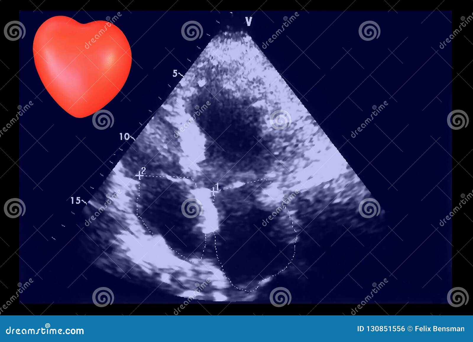 Cardiac Ultrasound Images . Doppler Echo Royalty-Free Stock Photo