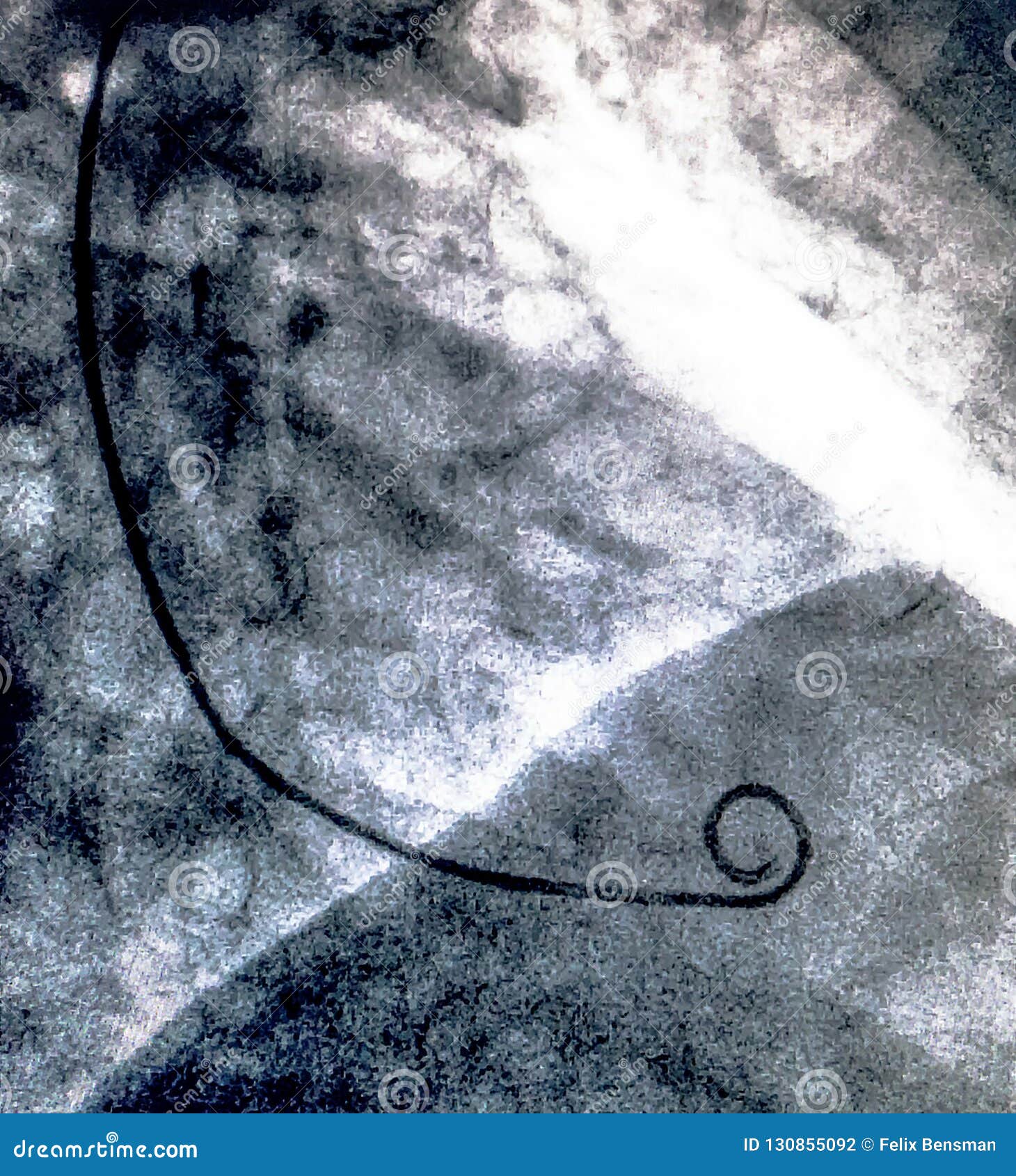 cardiac ventriculography. catheterization
