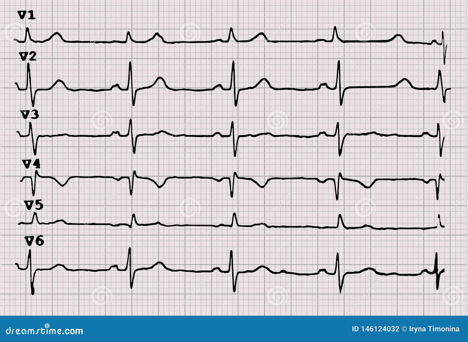 cardiogram. heartbeat. the graph on graph paper.