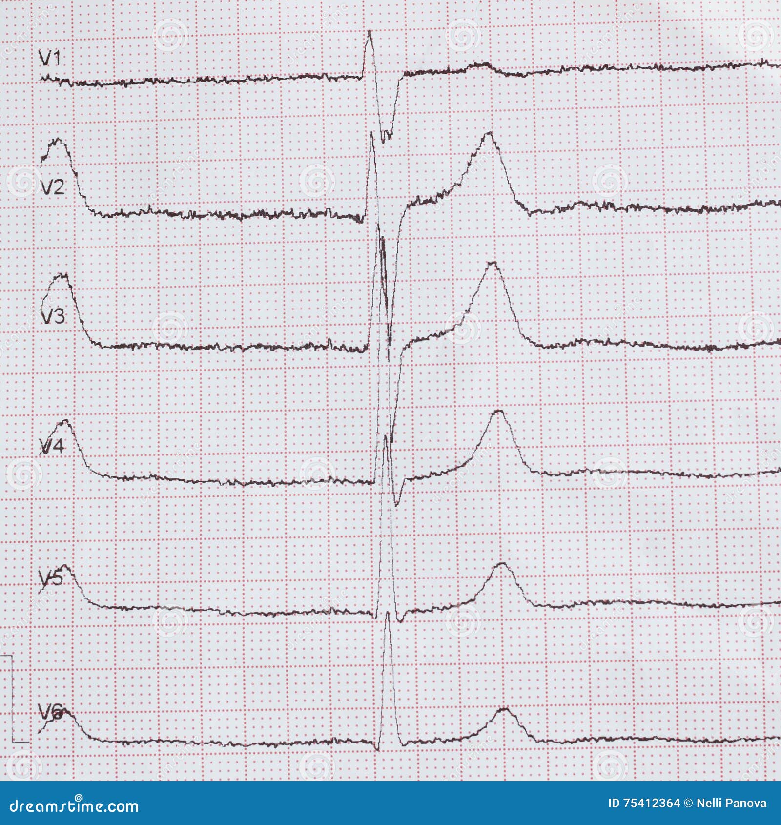 does finasteride affect heart rate