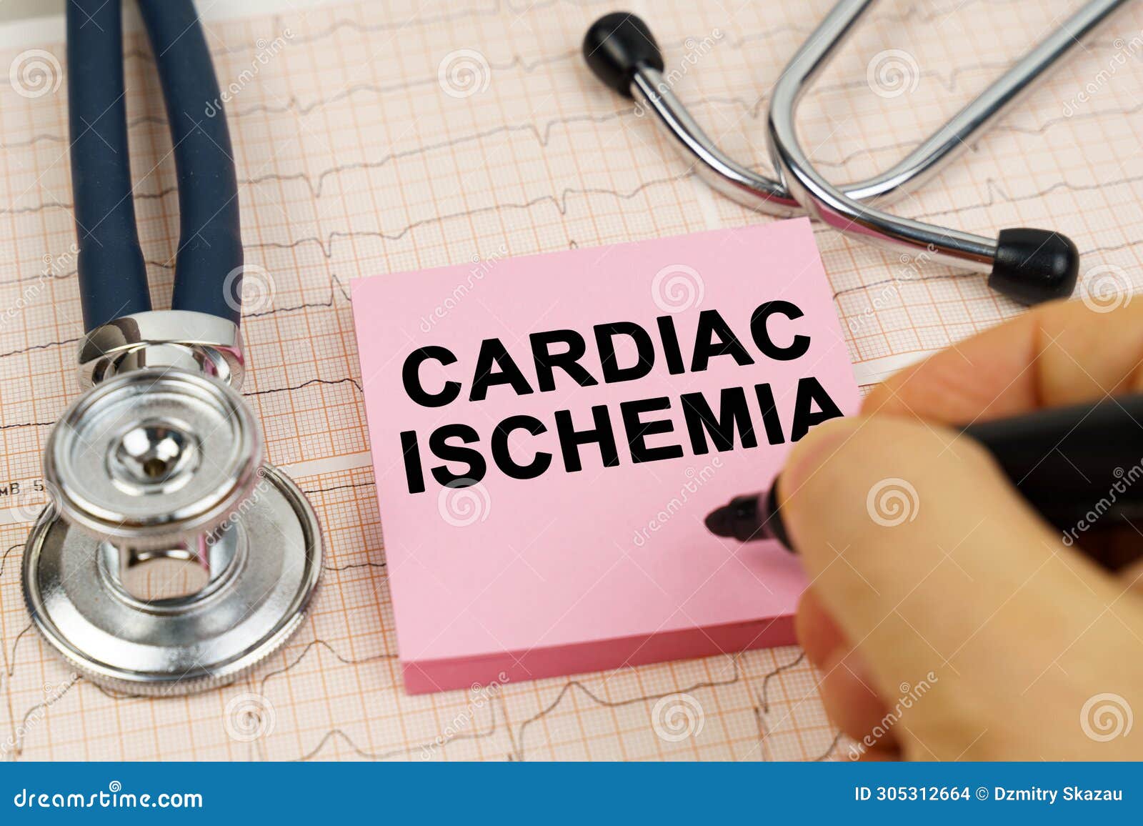 on the cardiograms there is a stethoscope and a sticker with the inscription - cardiac ischemia