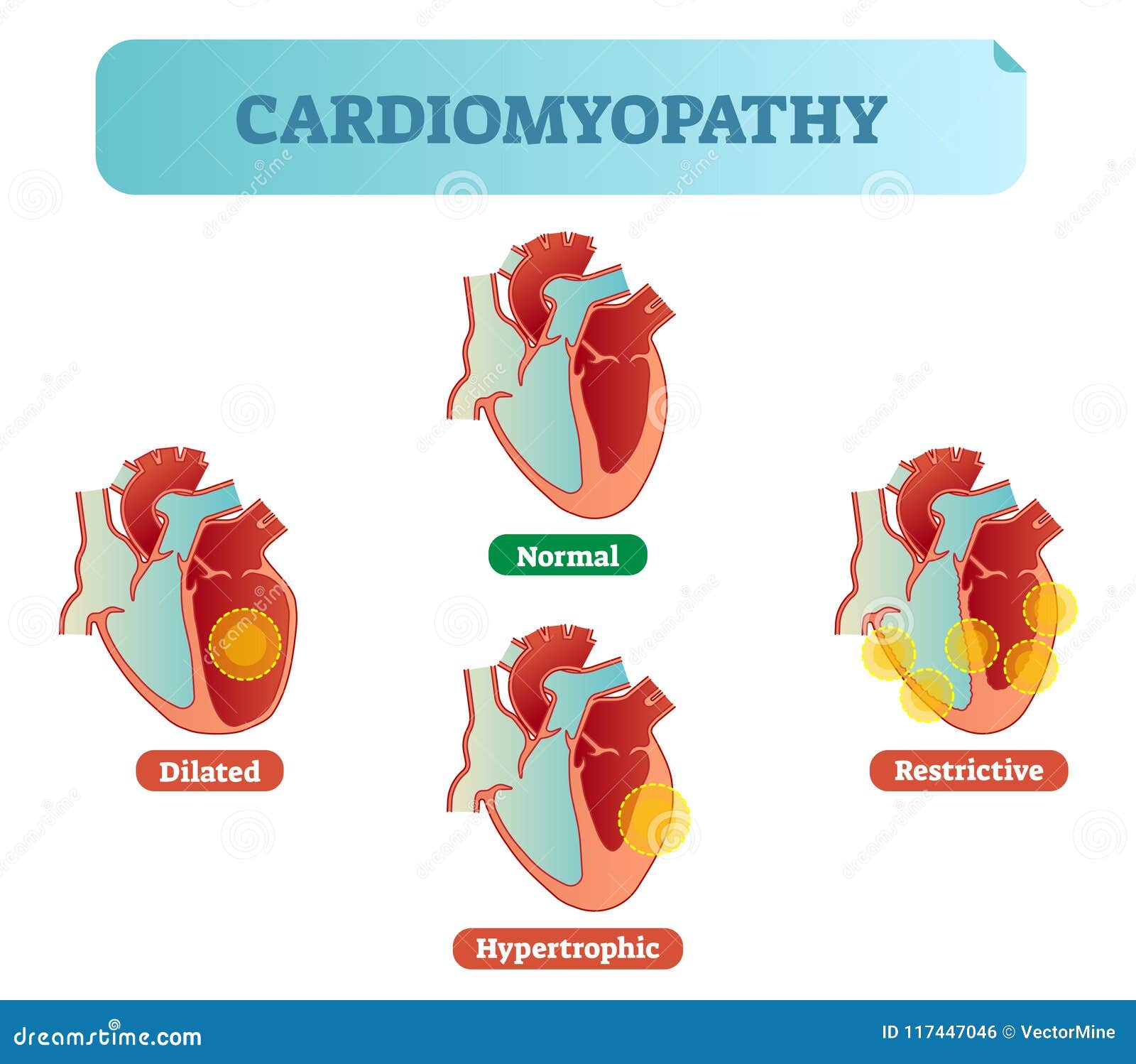 Cardiomyopathy Medical Disorders Cross Section Diagram ...
