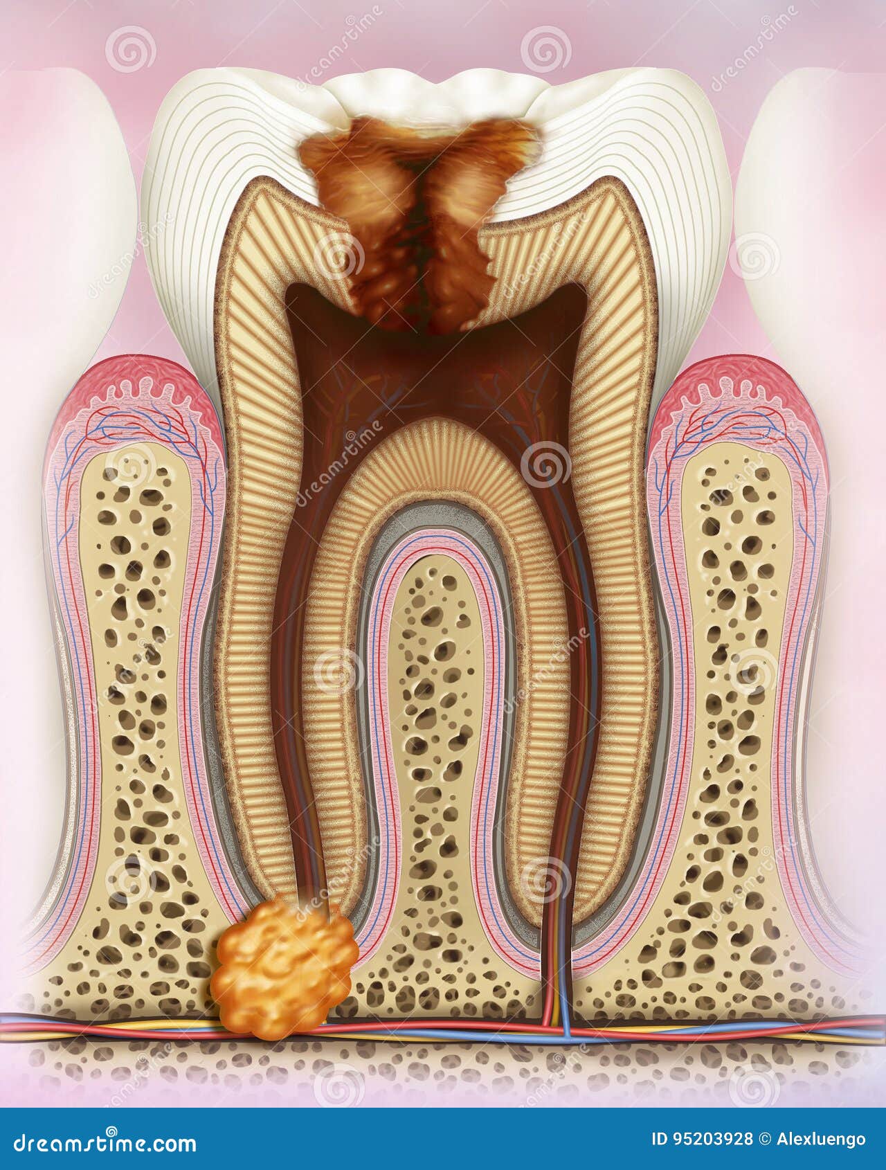 caries dental avanzada