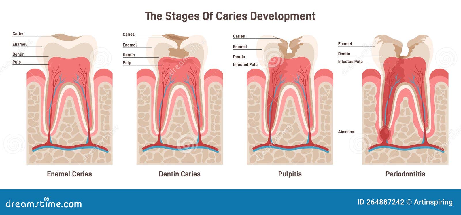 Caries Development. Dental Disease Stages: Enamel and Dentin Caries