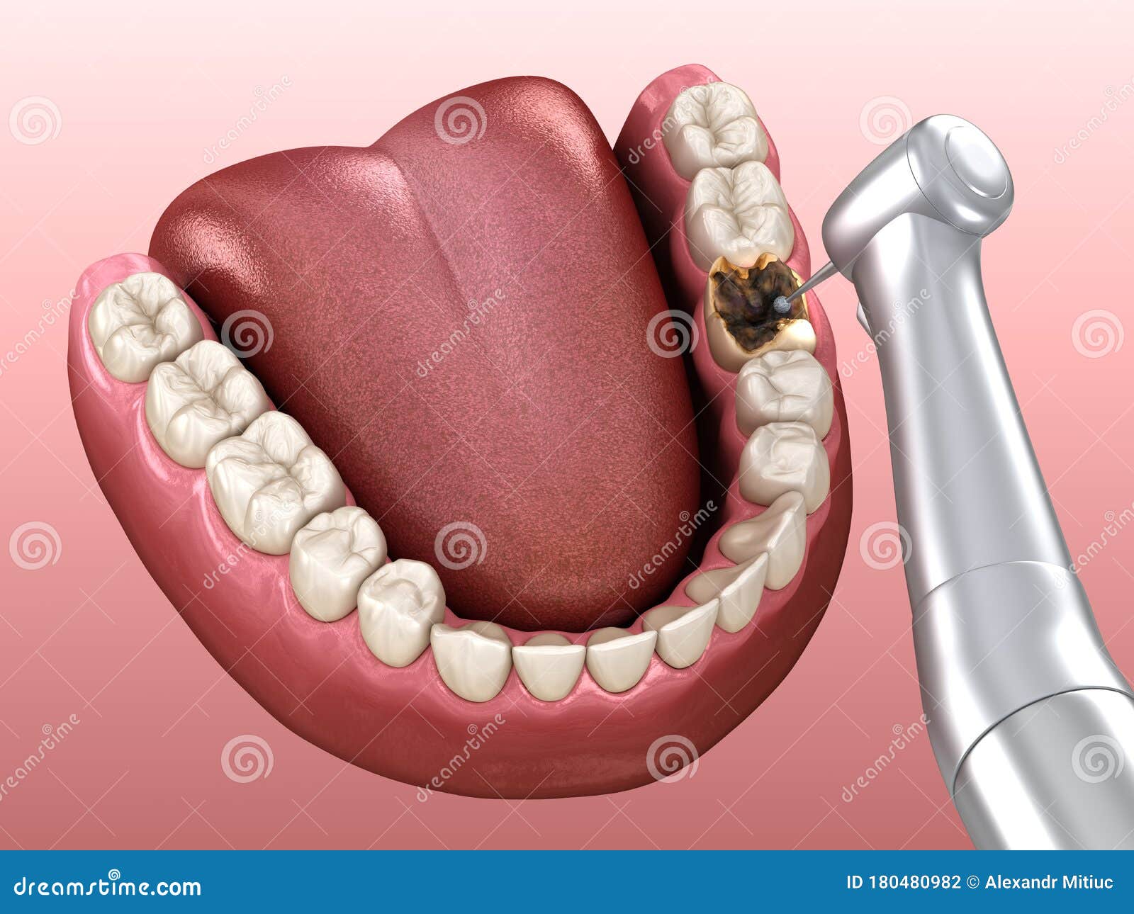 Caries Removing Process. Medically Accurate Tooth Illustration Stock