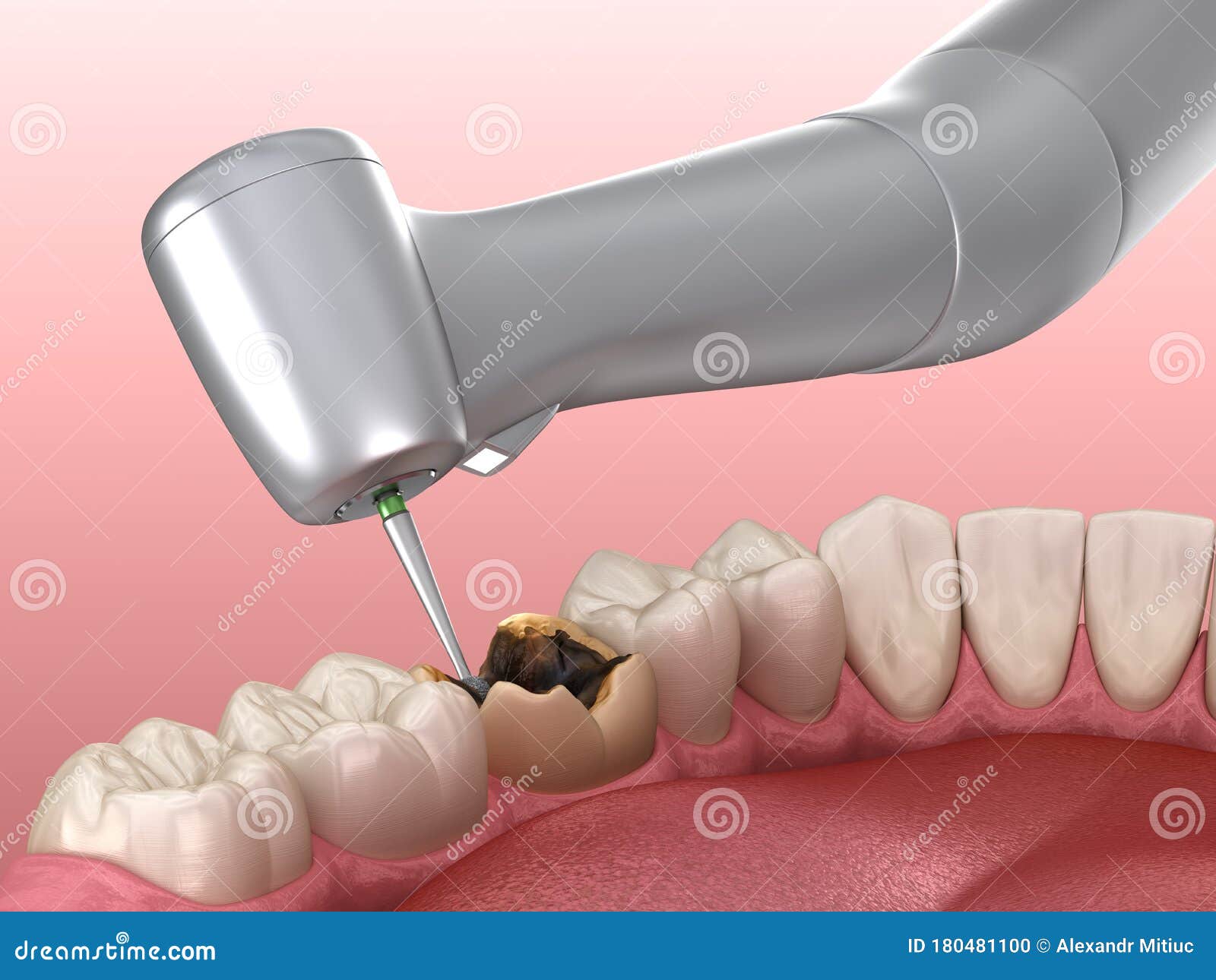 Caries Removing Process. Medically Accurate Tooth Illustration Stock