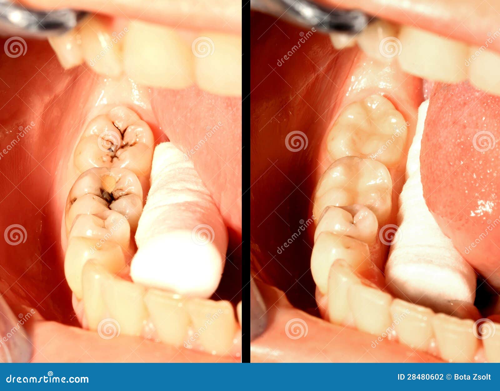 caries and restoration