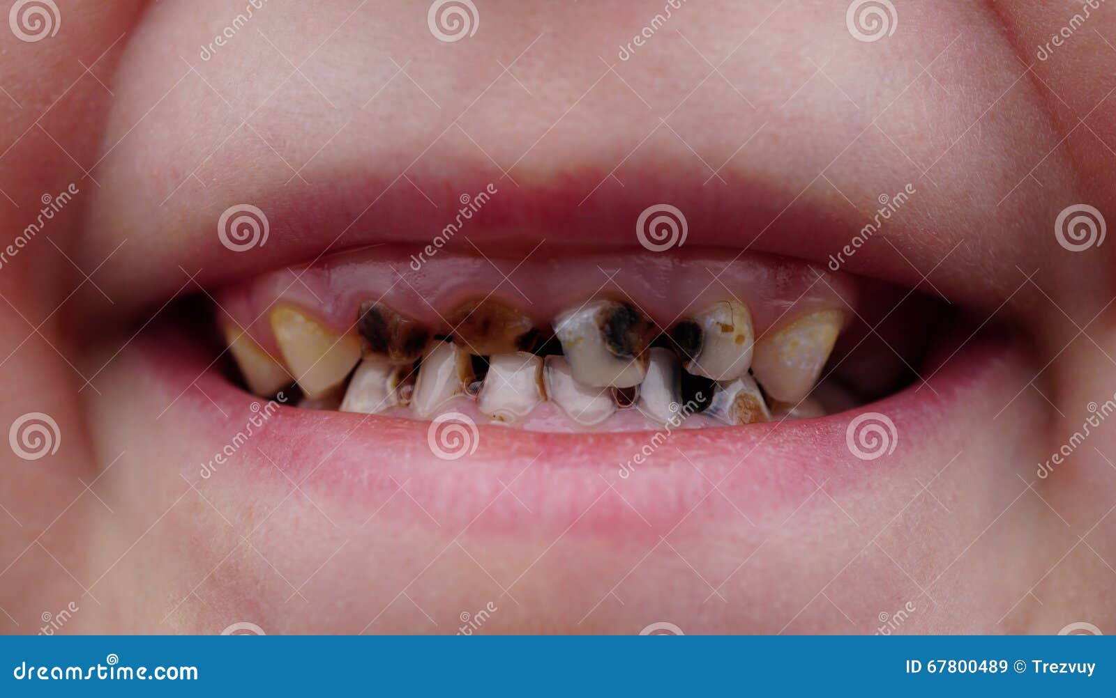 1 1 Child Bad Teeth Photos Free Royalty Free Stock Photos From Dreamstime 1 1 Child Bad Teeth Photos Free Royalty Free Stock Photos From Dreamstime