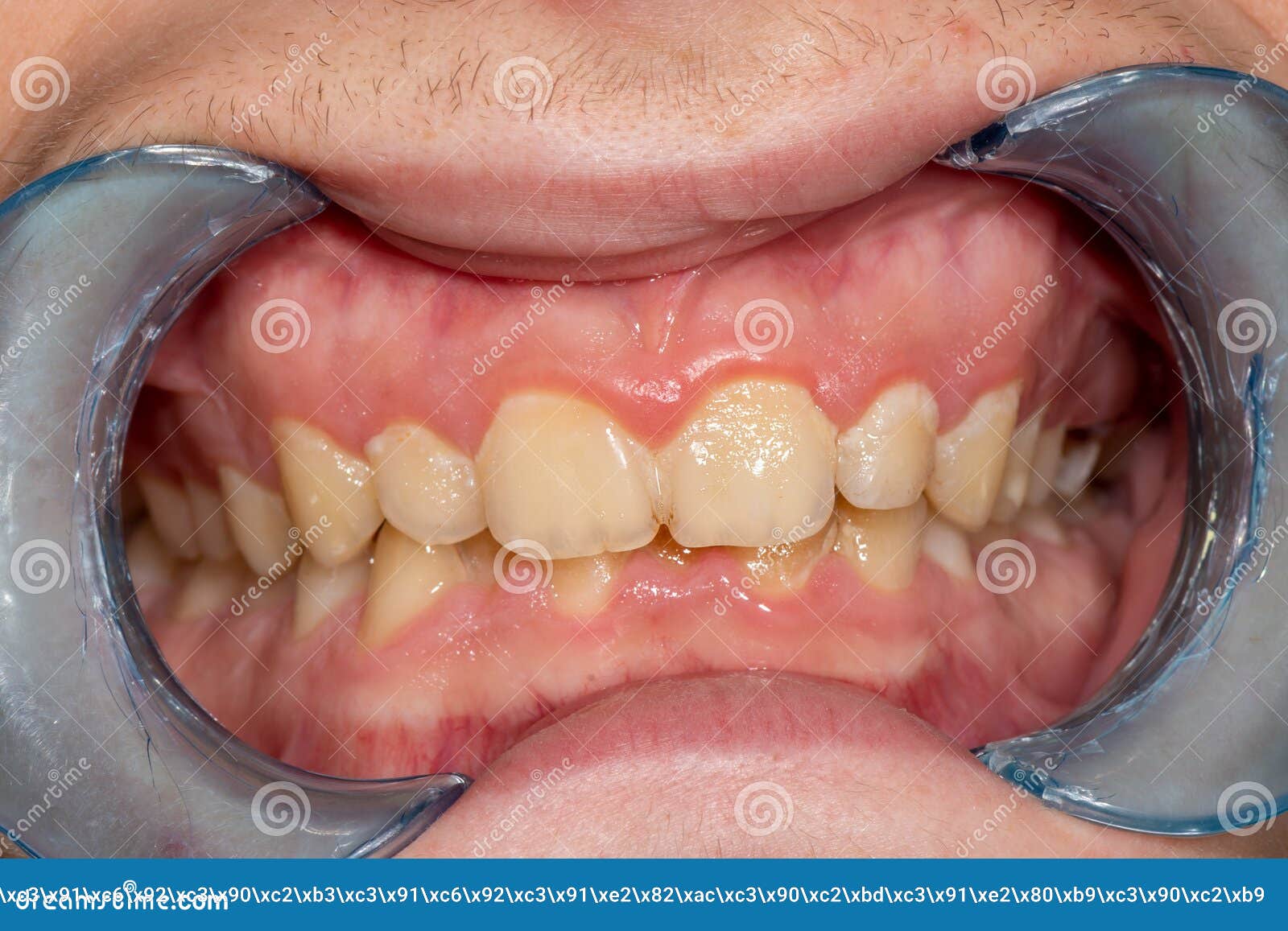 caries and tooth disease. filling with a dental composite photopolymer material using rubber dam. the concept of dental treatment