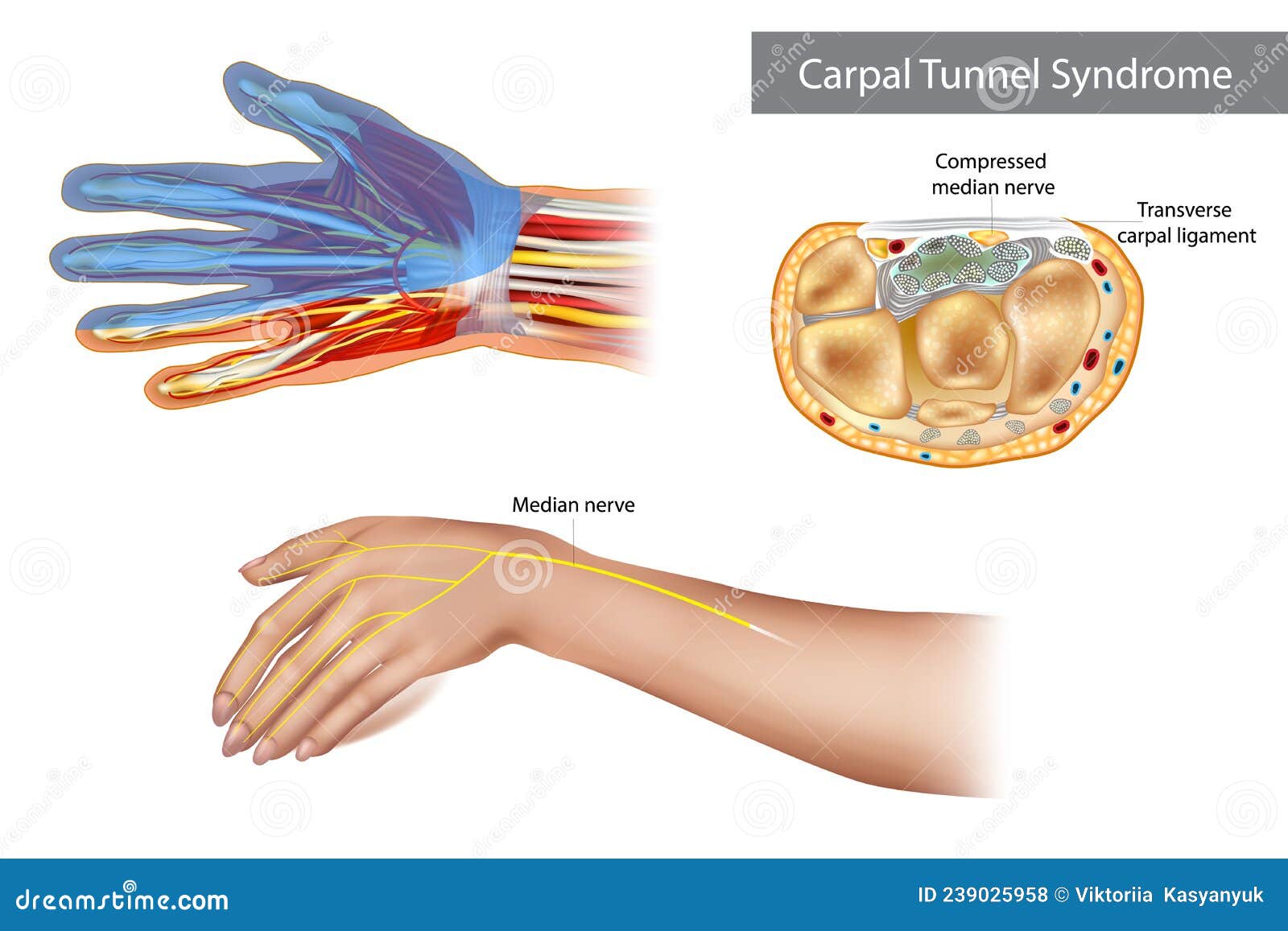 carpal tunnel syndrome. compressed median nerve. anatomy of the carpal tunnel, showing the median nerve.